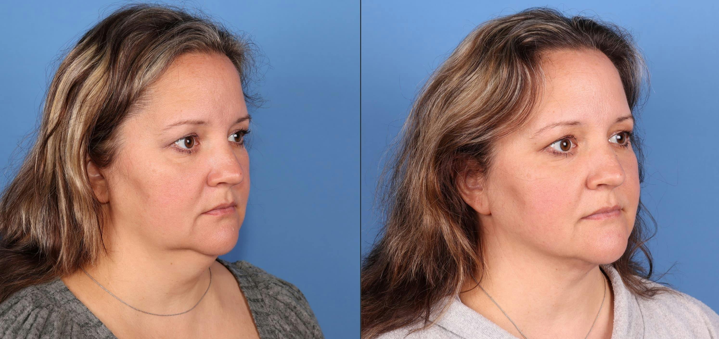 Face & Neck Before & After Gallery - Patient 399676 - Image 5
