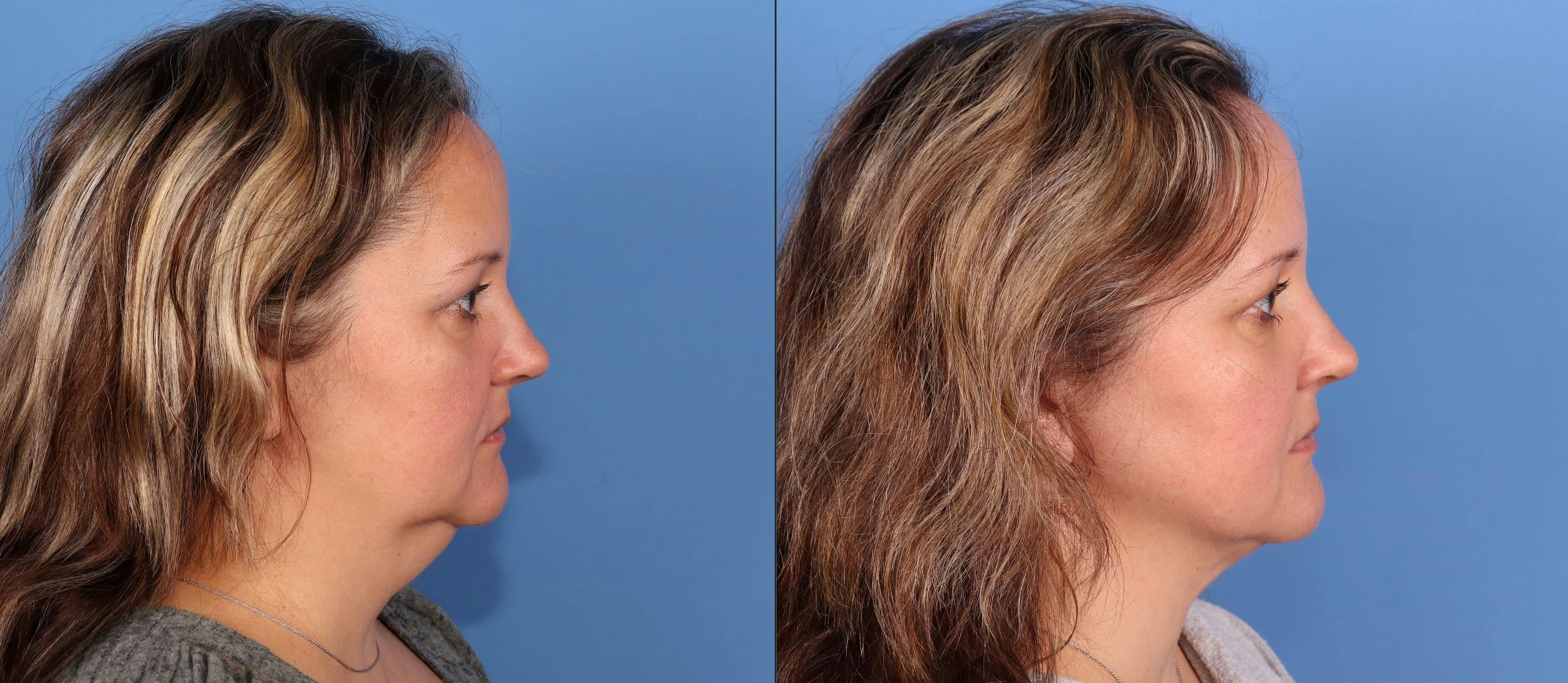 Face & Neck Before & After Gallery - Patient 399676 - Image 4