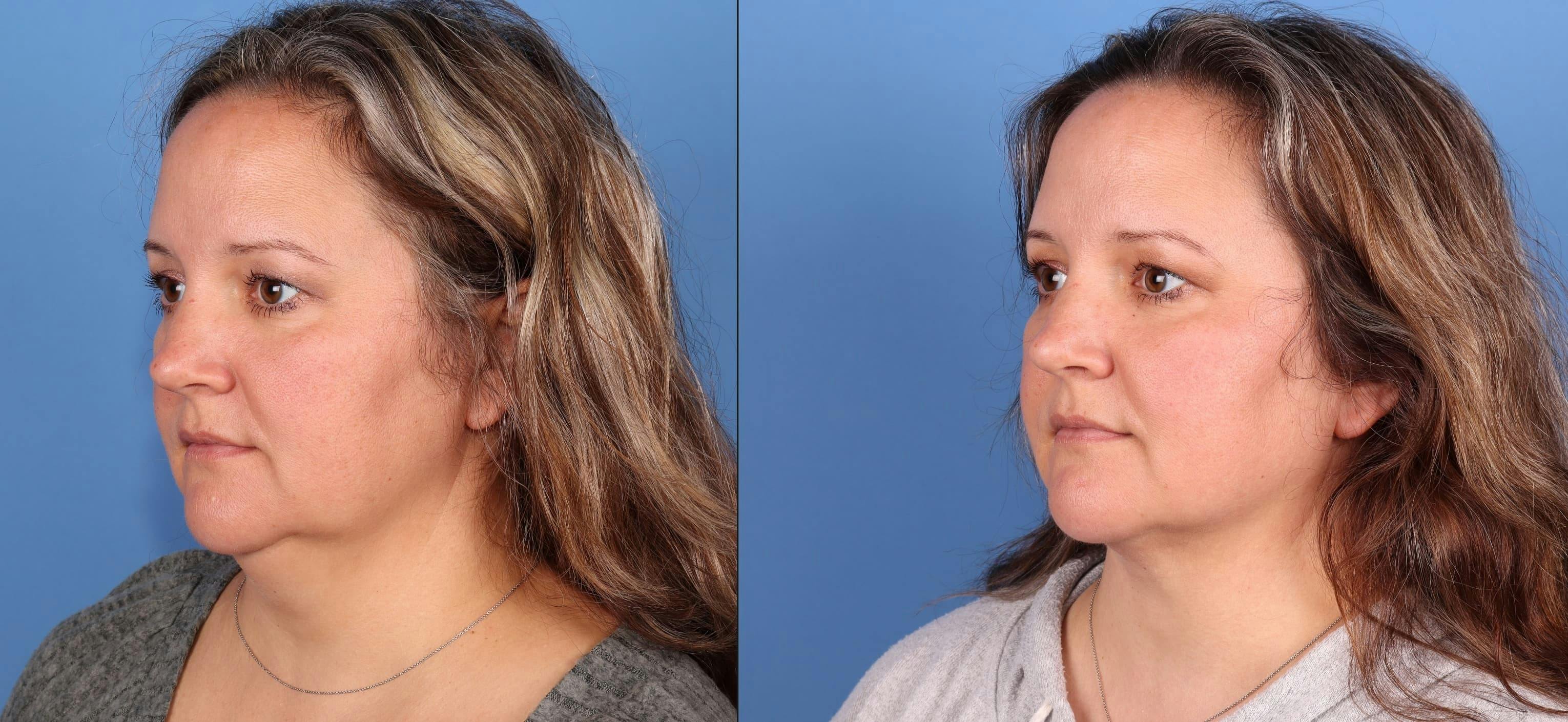 Face & Neck Before & After Gallery - Patient 399676 - Image 2