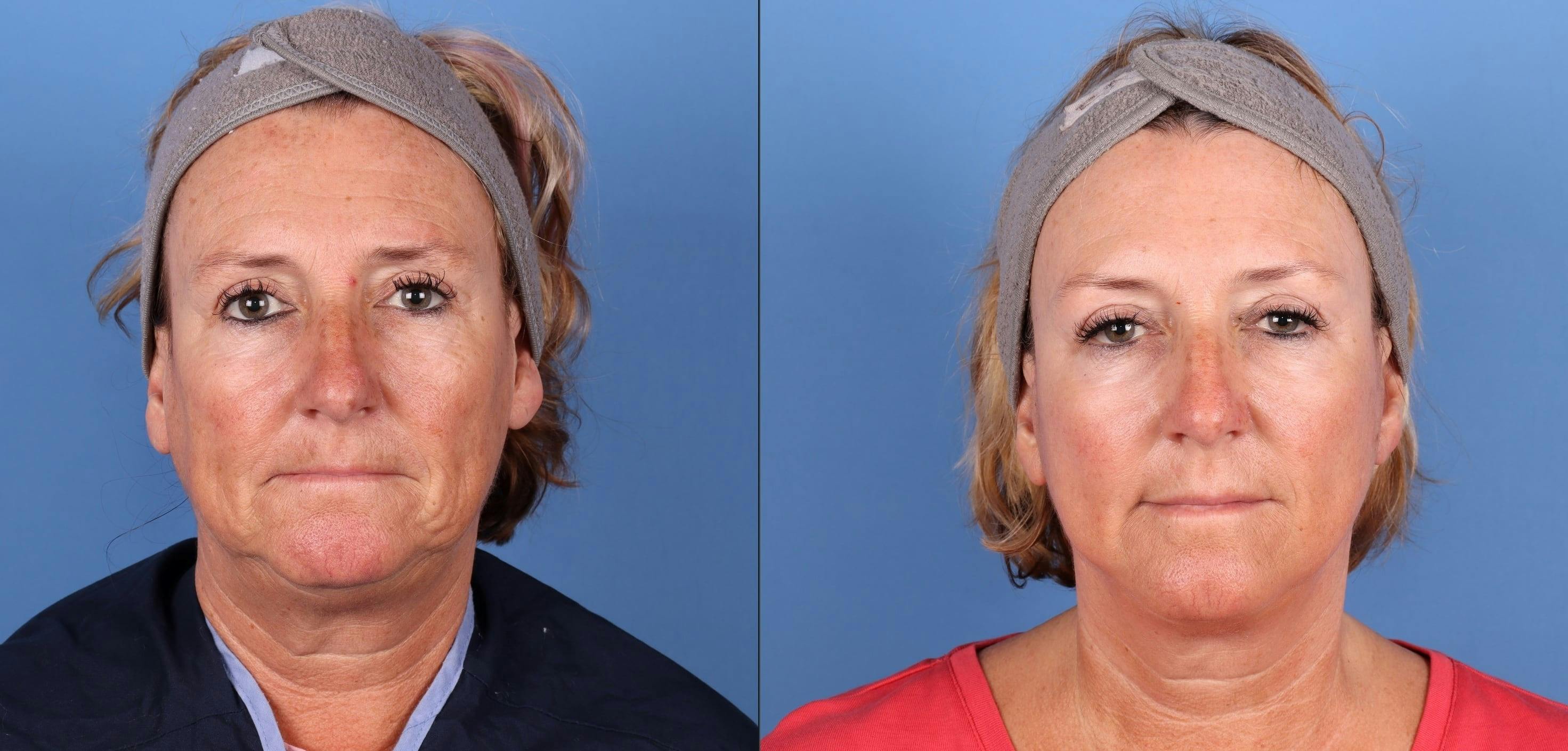 Mini Facelift Before & After Gallery - Patient 514741 - Image 1