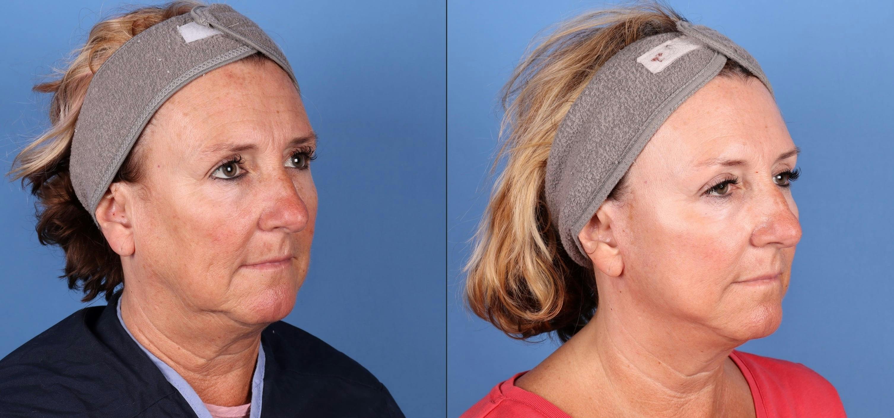 Mini Facelift Before & After Gallery - Patient 514741 - Image 2