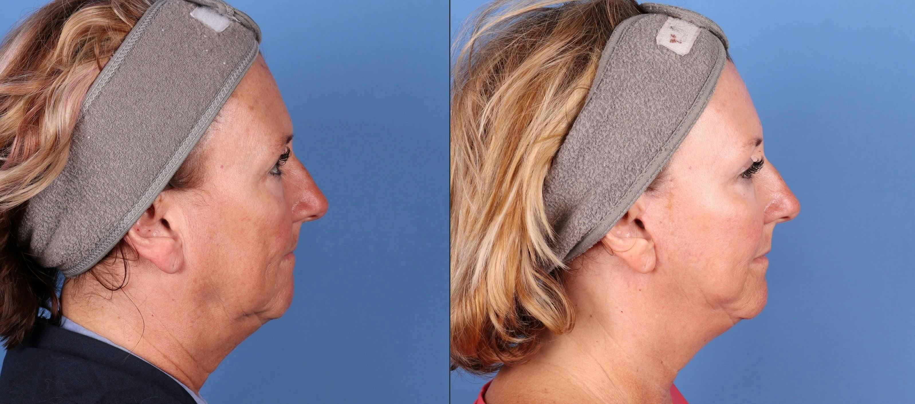 Mini Facelift Before & After Gallery - Patient 514741 - Image 3