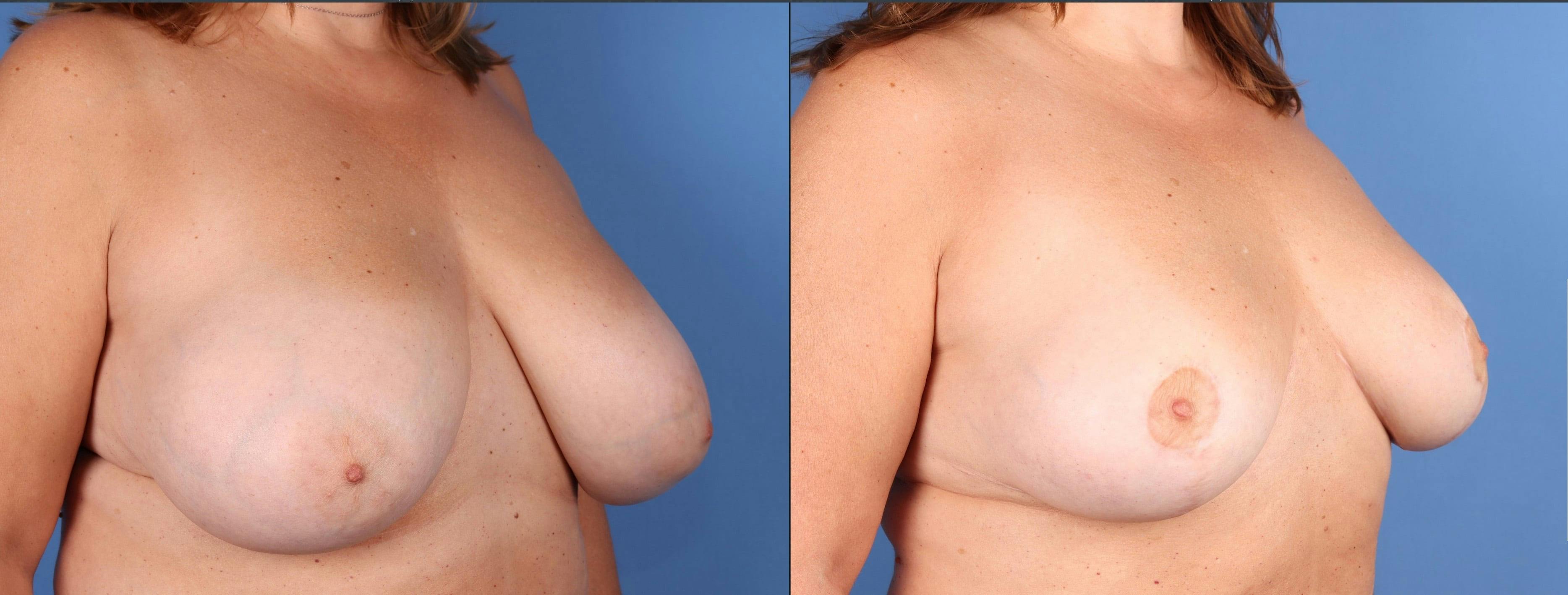 Breast Reduction Before & After Gallery - Patient 422412 - Image 2
