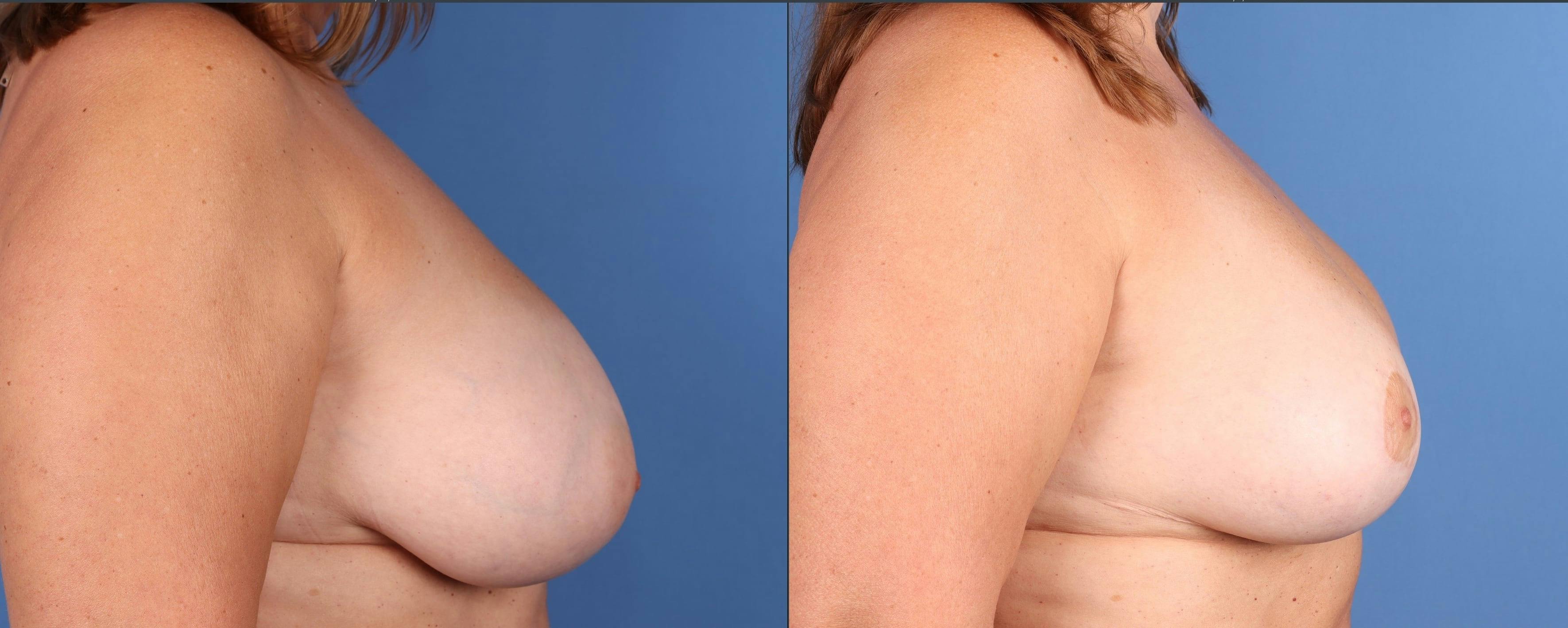 Breast Reduction Before & After Gallery - Patient 422412 - Image 3
