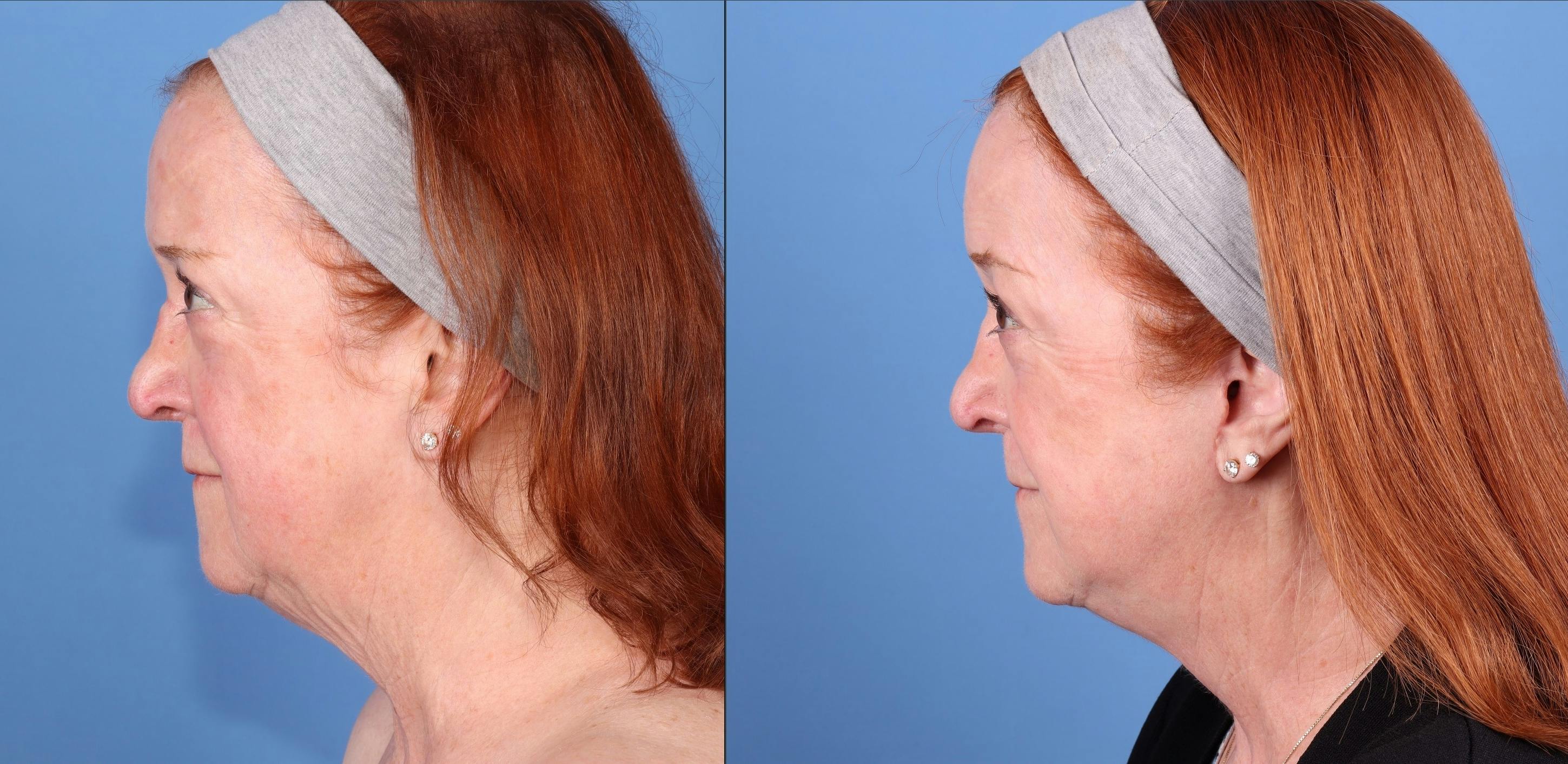 Facial Fillers Before & After Gallery - Patient 329844 - Image 3