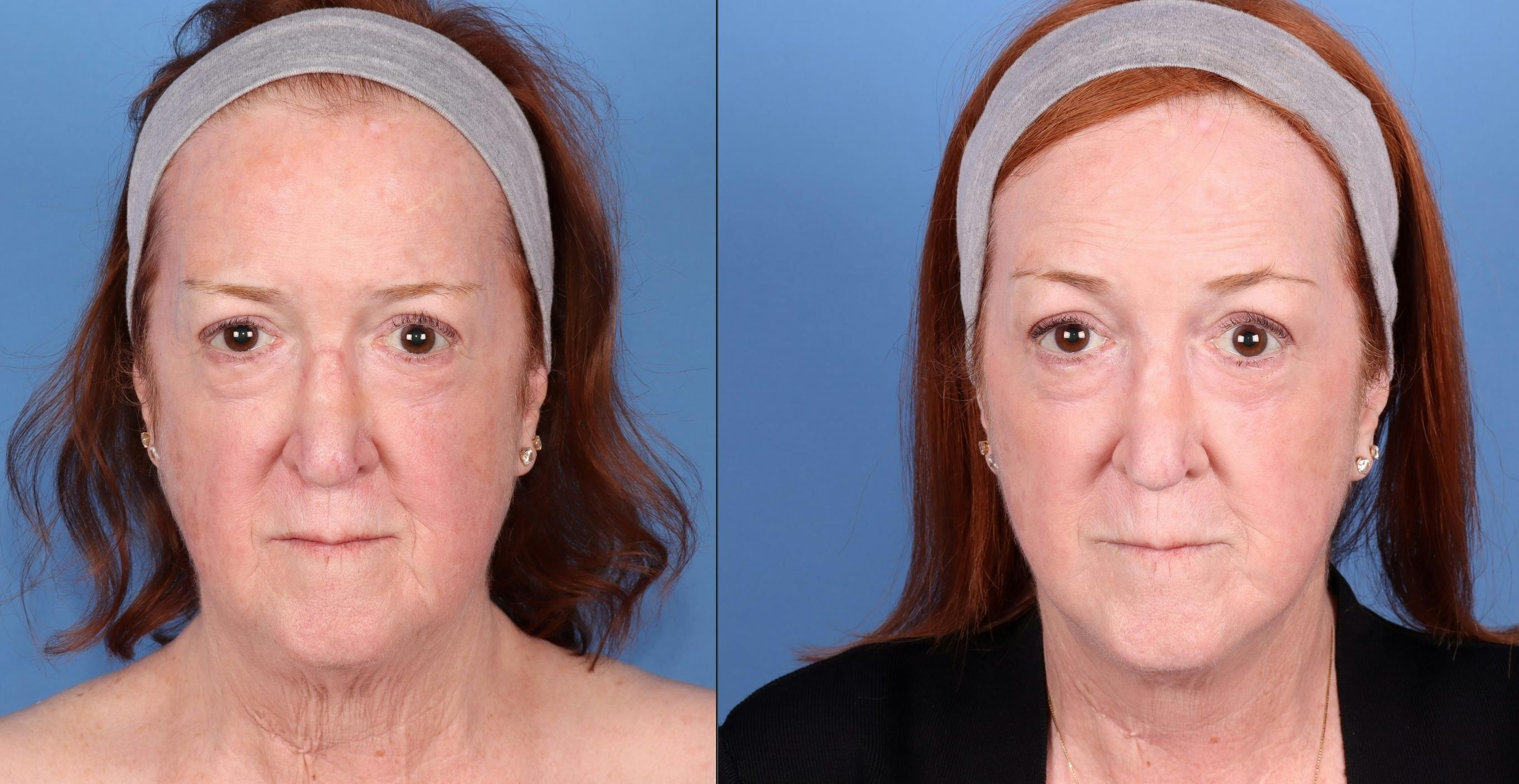 Facial Fillers Before & After Gallery - Patient 329844 - Image 1