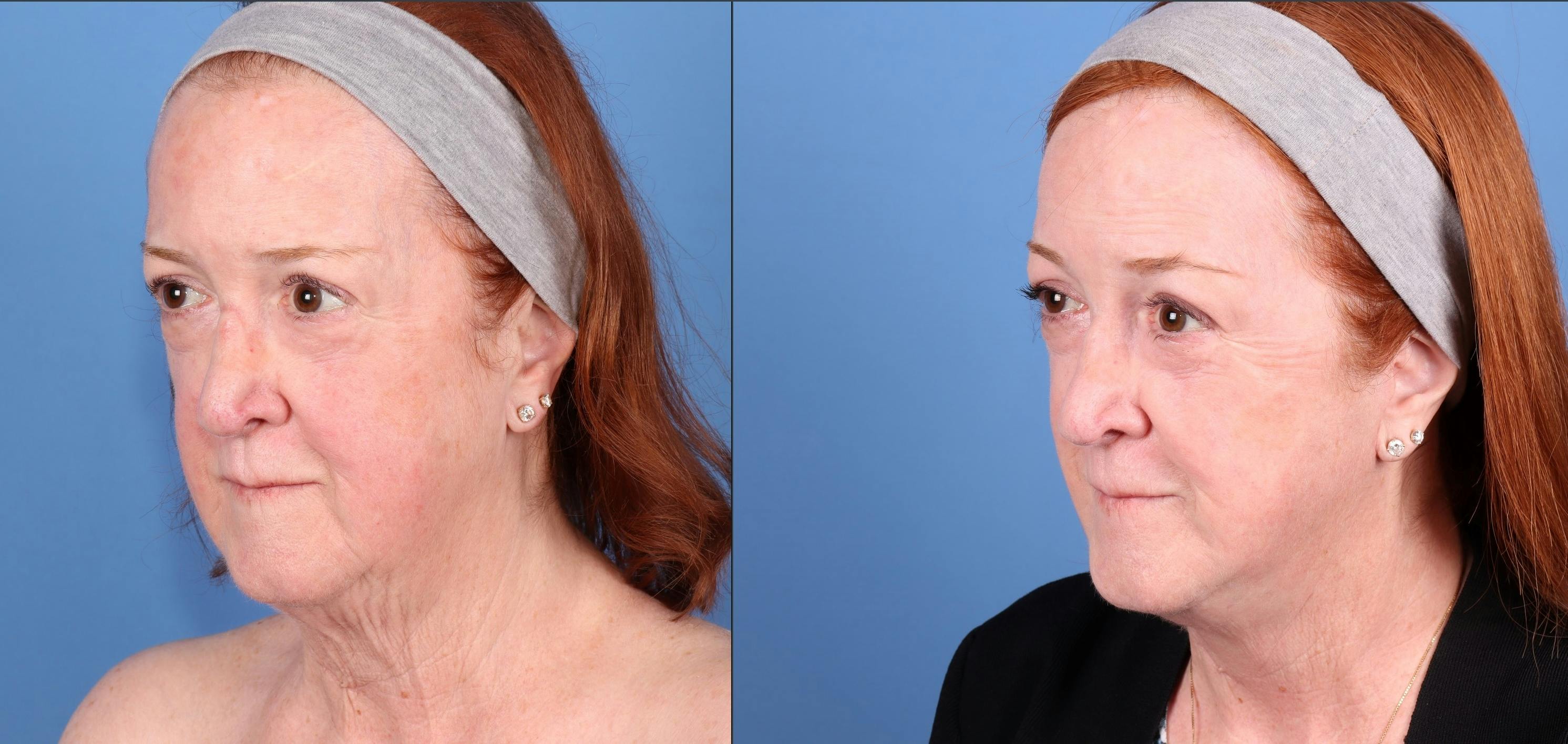 Facial Fillers Before & After Gallery - Patient 329844 - Image 2