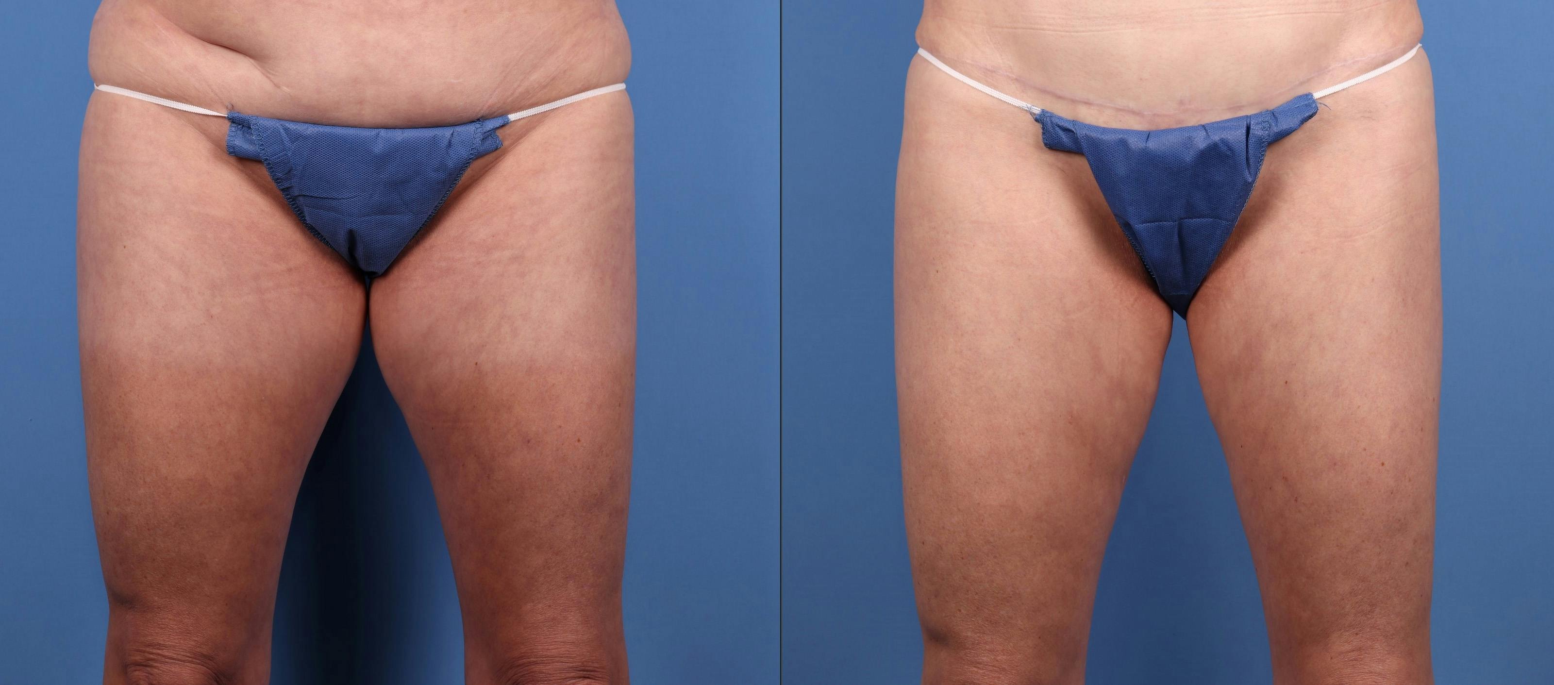 Thighs Before & After Gallery - Patient 515603 - Image 1
