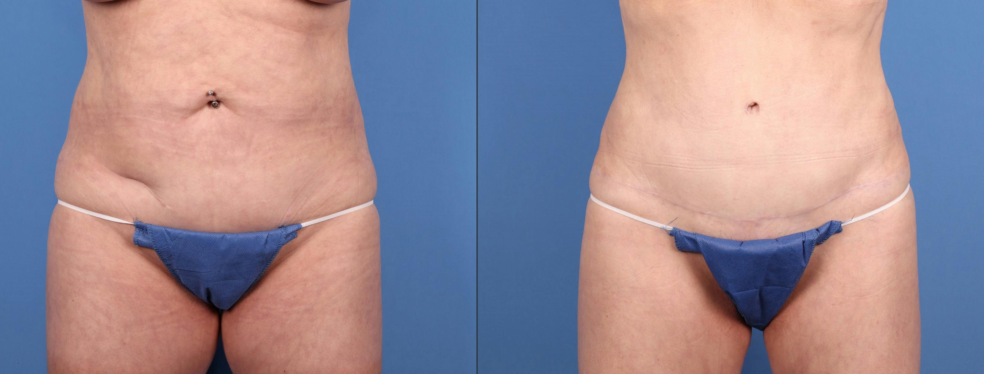 Tummy Tuck Before & After Gallery - Patient 316116 - Image 1