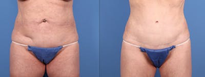 Tummy Tuck Before & After Gallery - Patient 316116 - Image 1