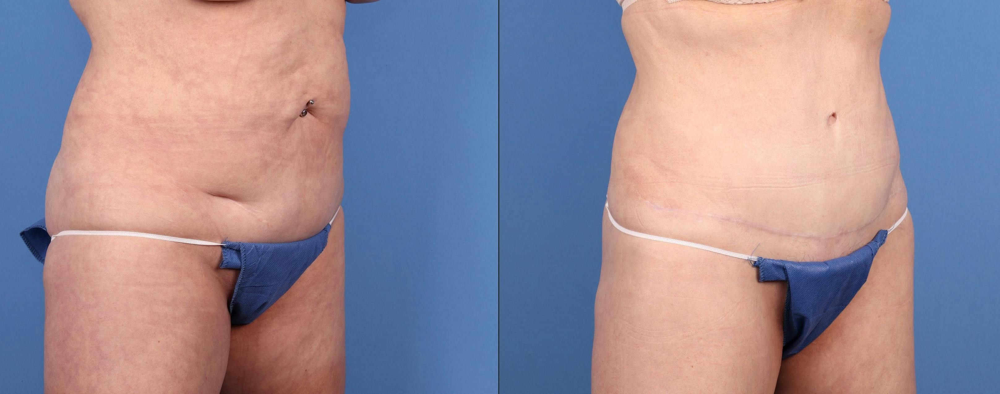 Tummy Tuck Before & After Gallery - Patient 316116 - Image 2