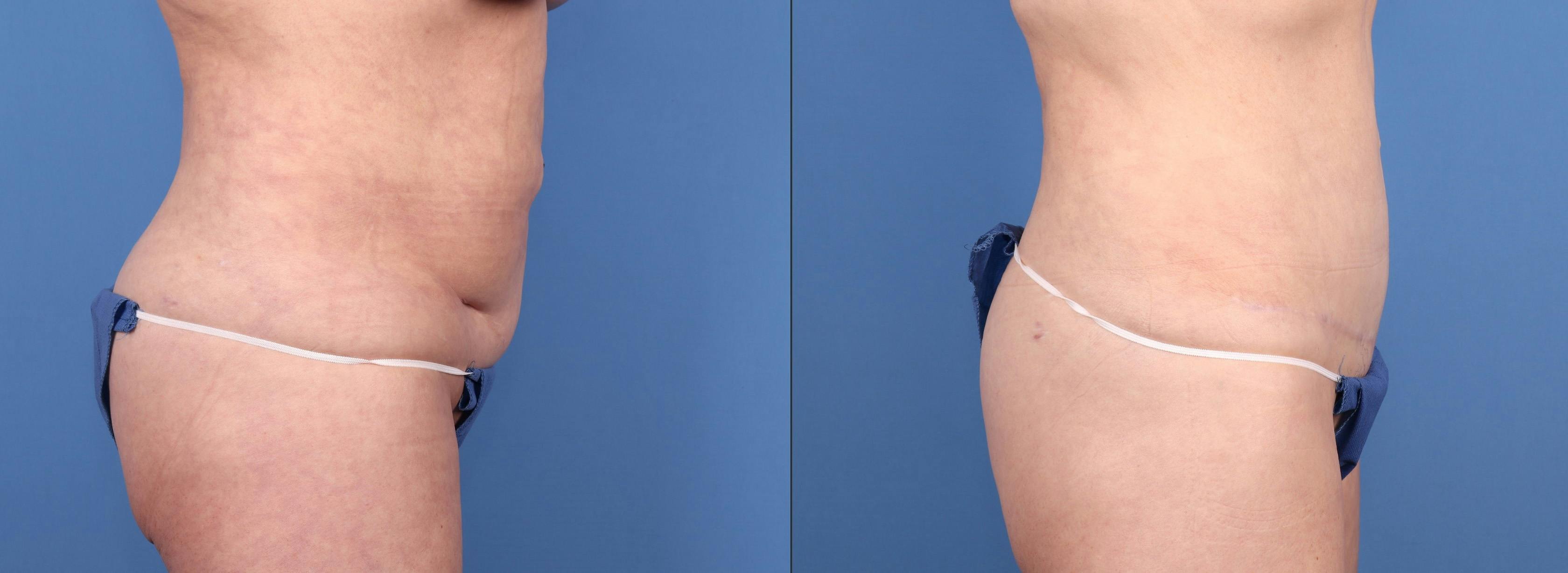 Tummy Tuck Before & After Gallery - Patient 316116 - Image 3