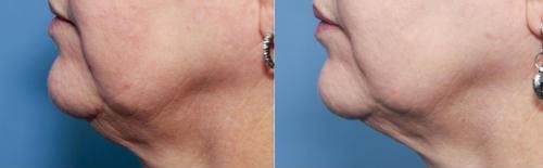 Neck Lift Before & After Gallery - Patient 58213315 - Image 1