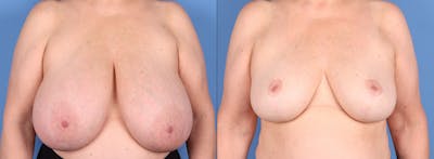 Breast Reduction Before & After Gallery - Patient 171692 - Image 1