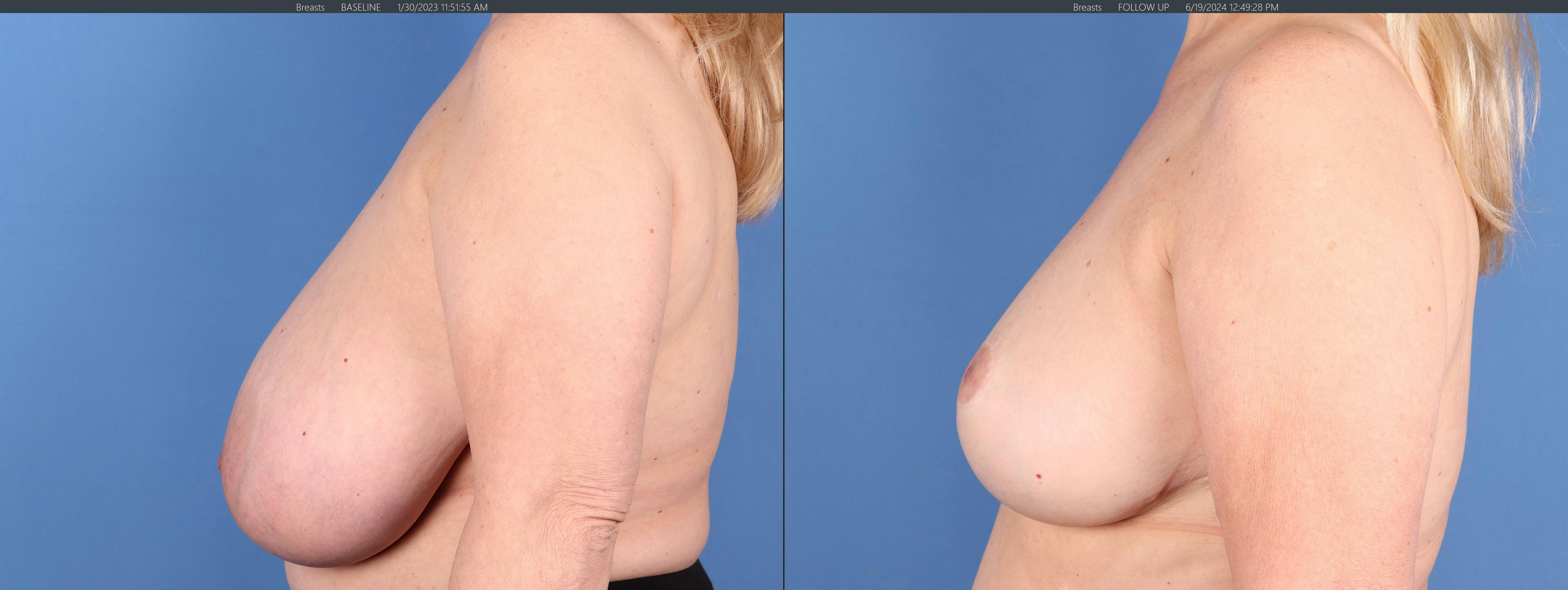 Breast Reduction Before & After Gallery - Patient 171692 - Image 3