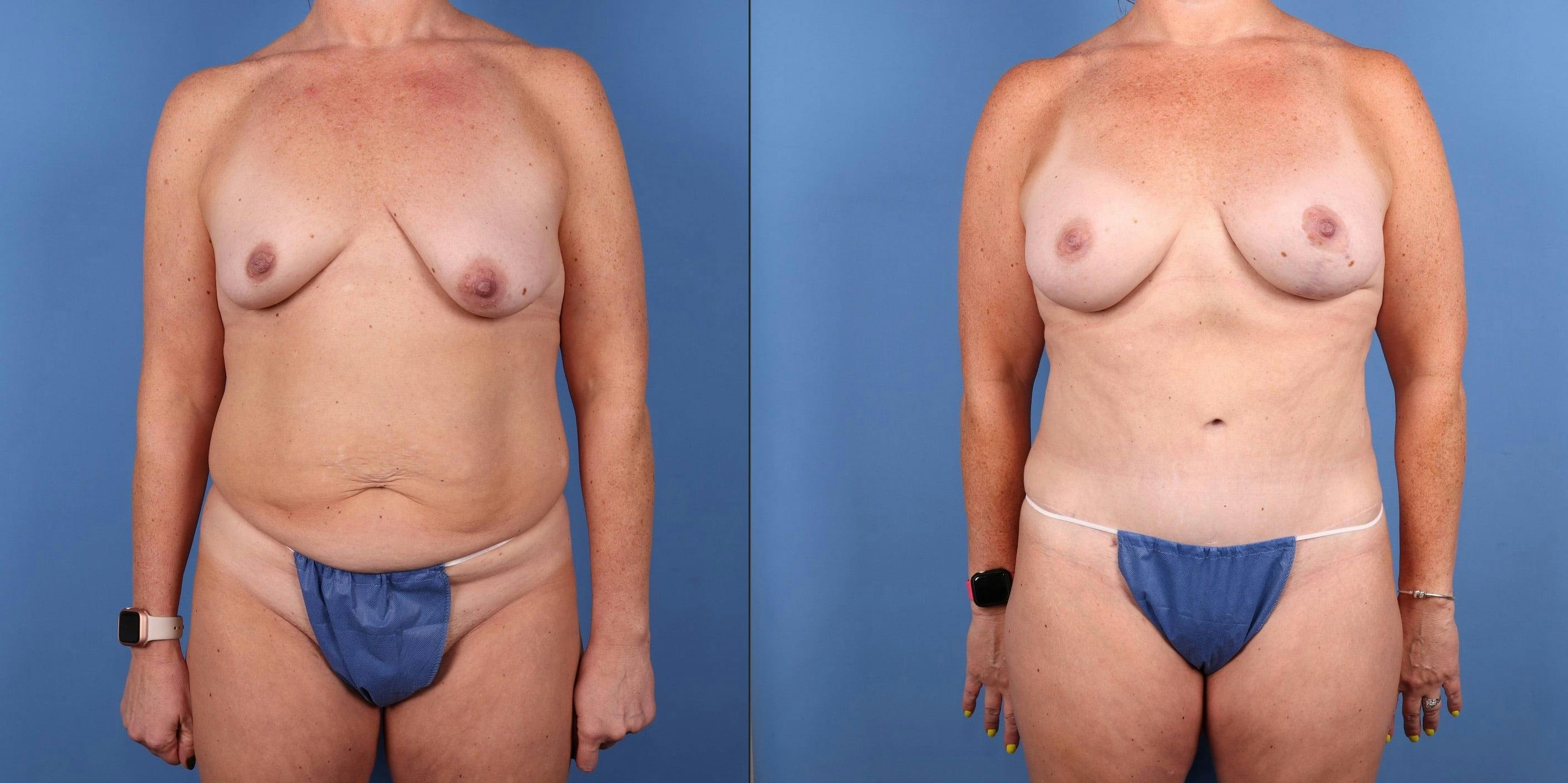 Mommy Makeover Before & After Gallery - Patient 335402 - Image 1