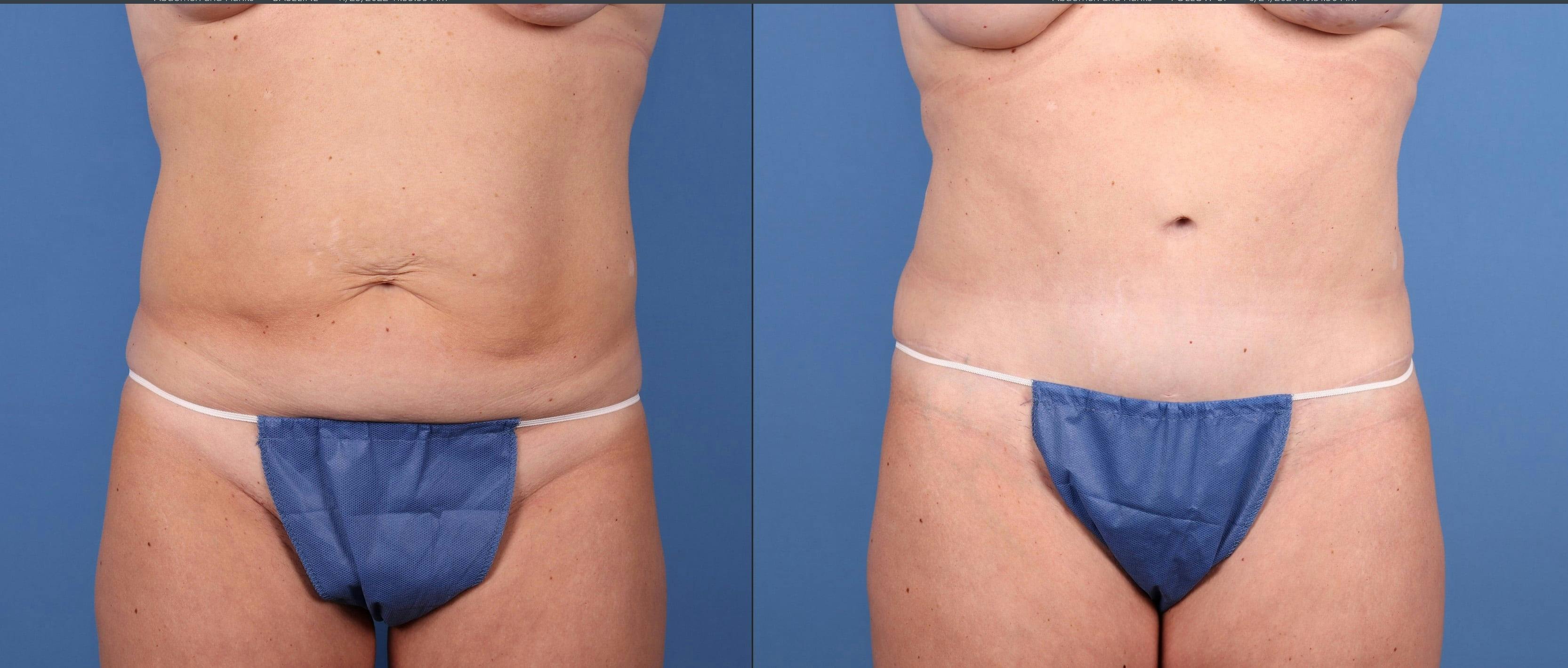 Tummy Tuck Before & After Gallery - Patient 195168 - Image 1