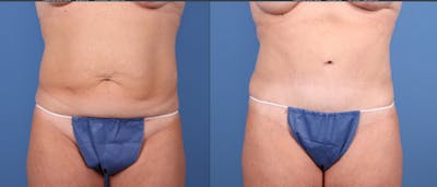 Tummy Tuck Before & After Gallery - Patient 195168 - Image 1