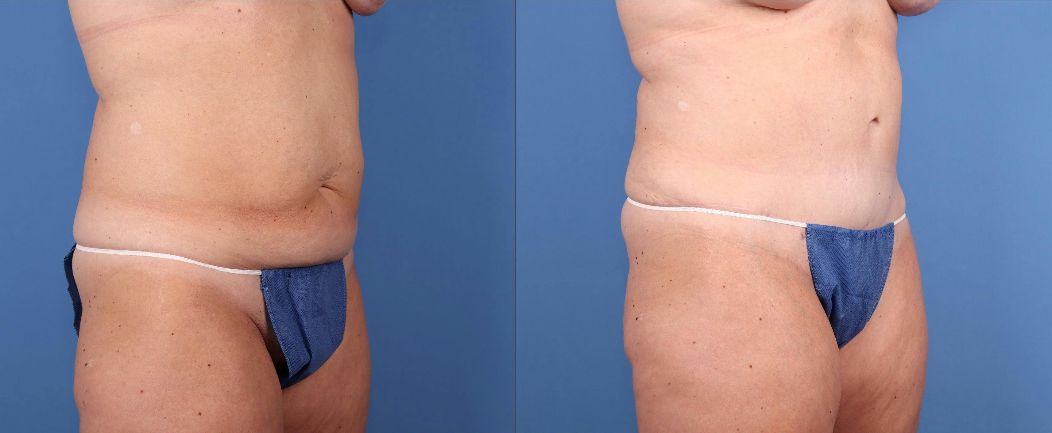 Tummy Tuck Before & After Gallery - Patient 195168 - Image 2