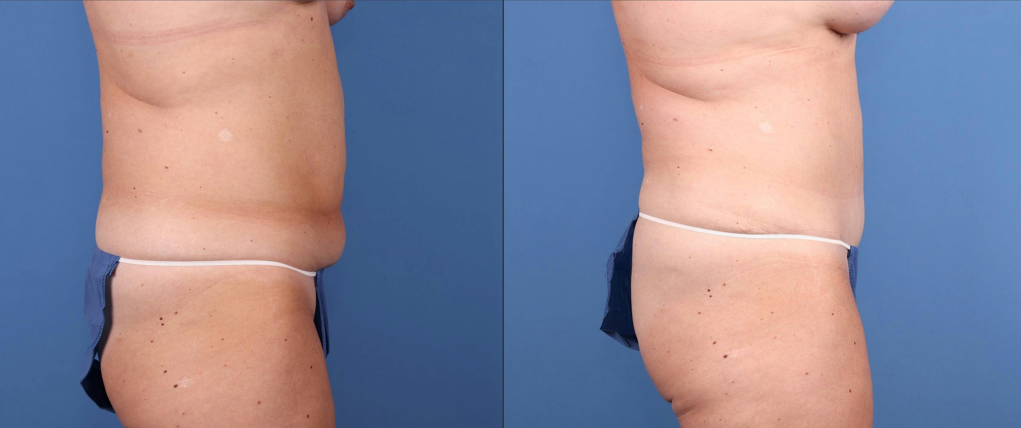 Tummy Tuck Before & After Gallery - Patient 195168 - Image 3
