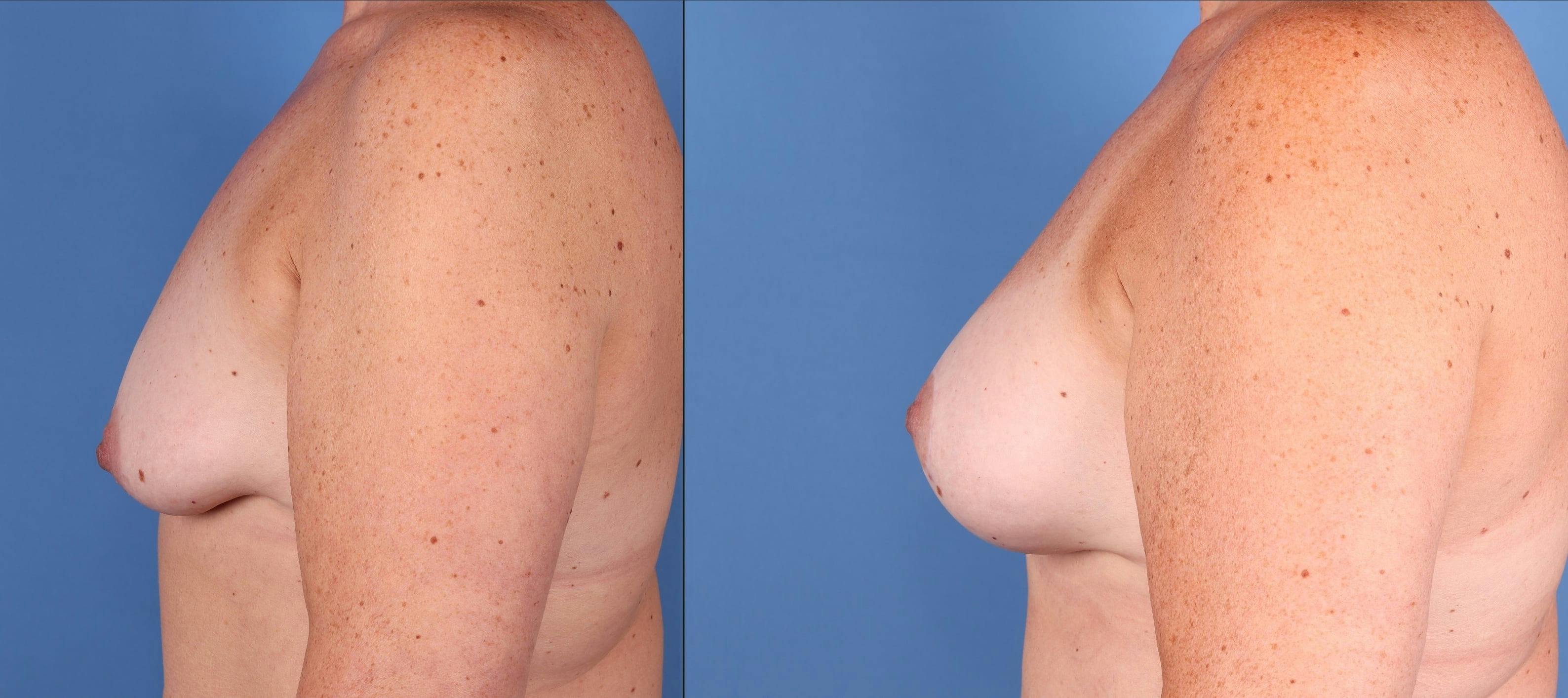 Breast Lift with Augmentation Before & After Gallery - Patient 355456 - Image 4