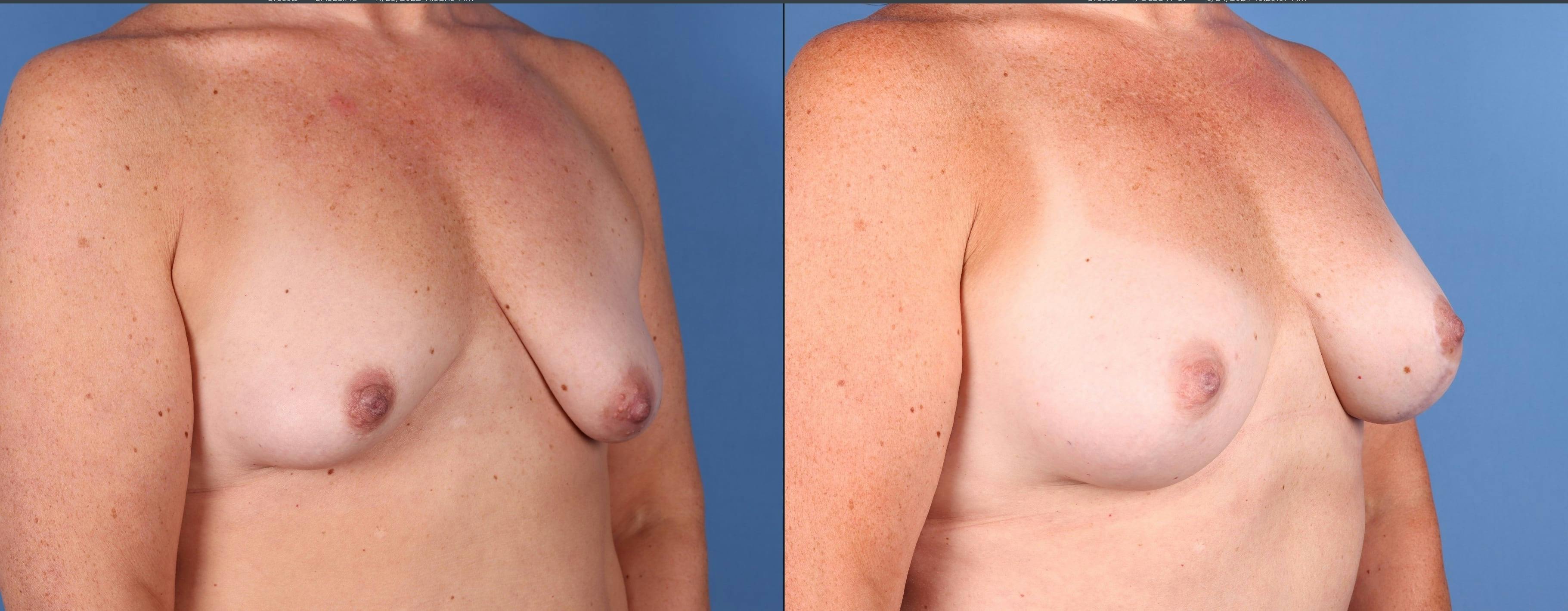 Breast Lift with Augmentation Before & After Gallery - Patient 355456 - Image 3