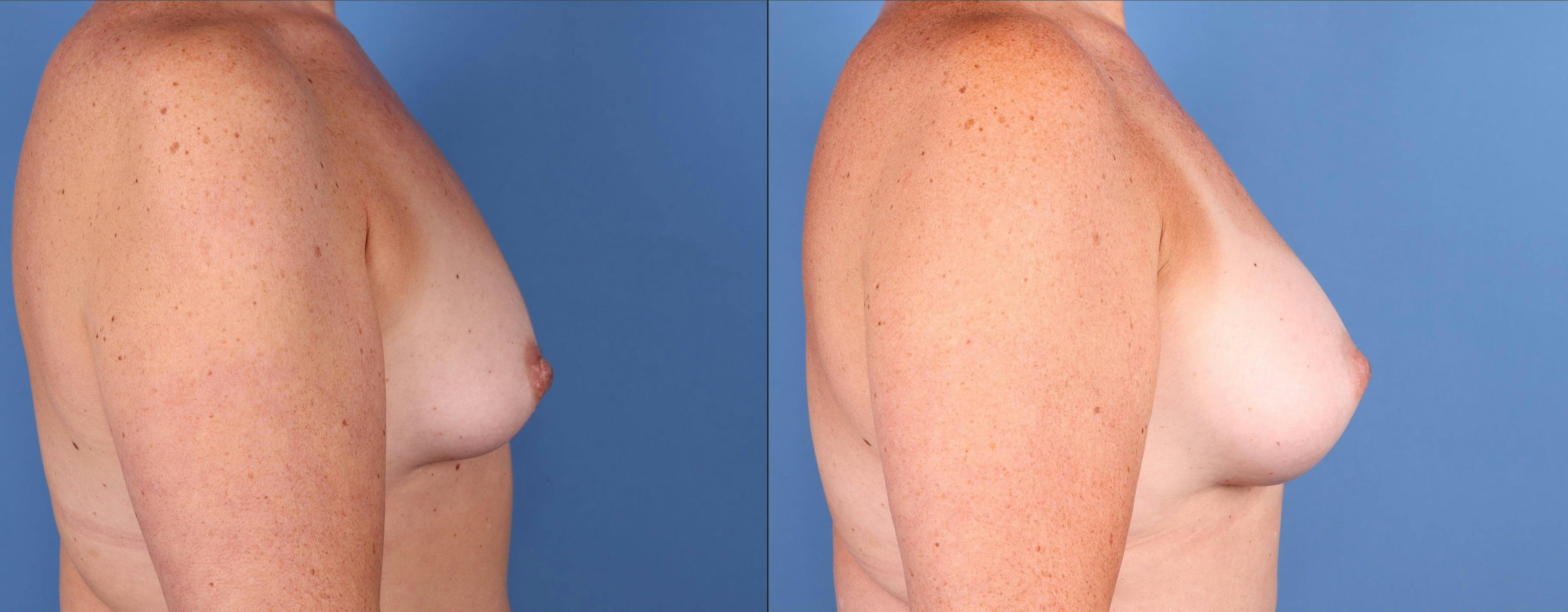 Breast Lift with Augmentation Before & After Gallery - Patient 355456 - Image 2