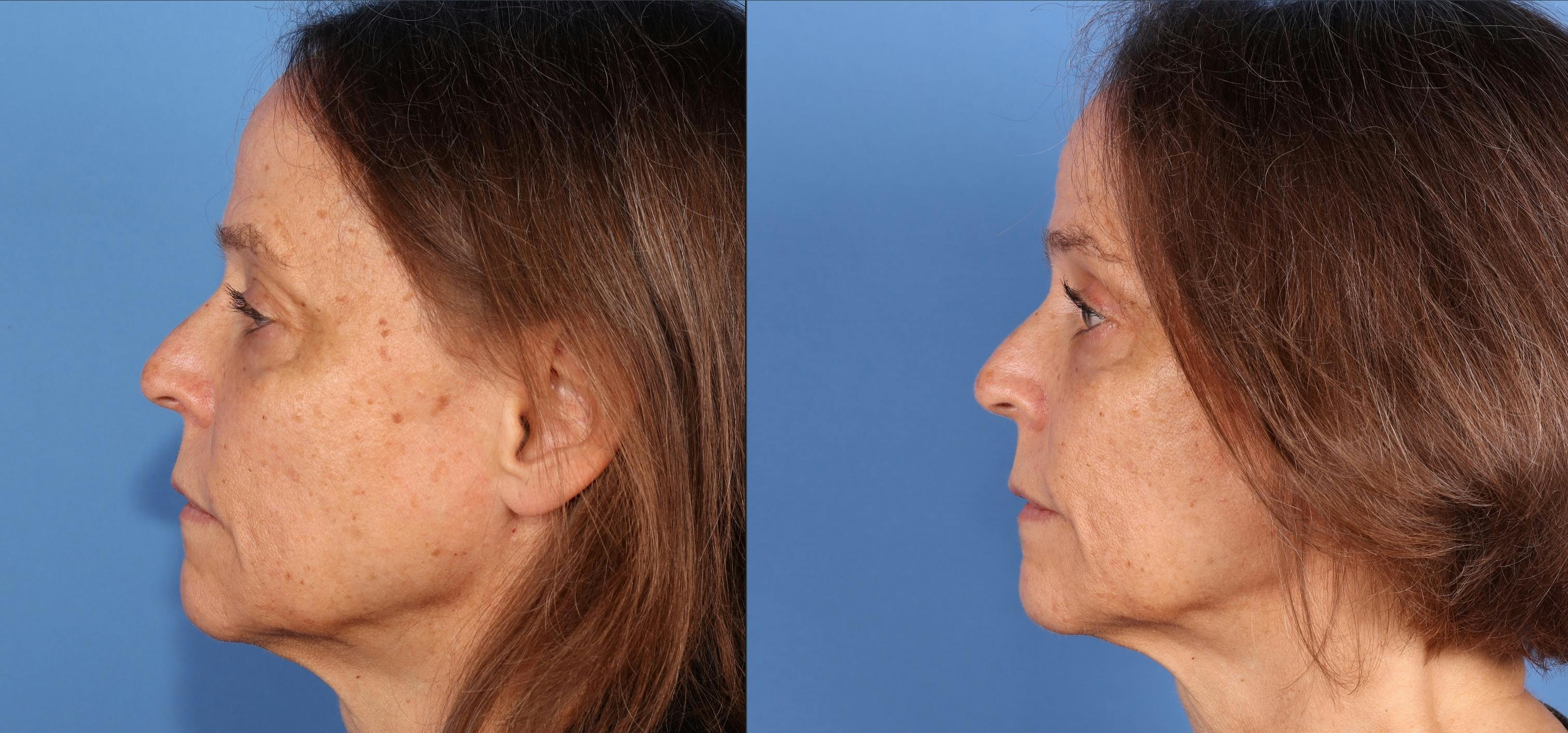 Eyelid Surgery (Upper Blepharoplasty) Before & After Gallery - Patient 331702 - Image 3
