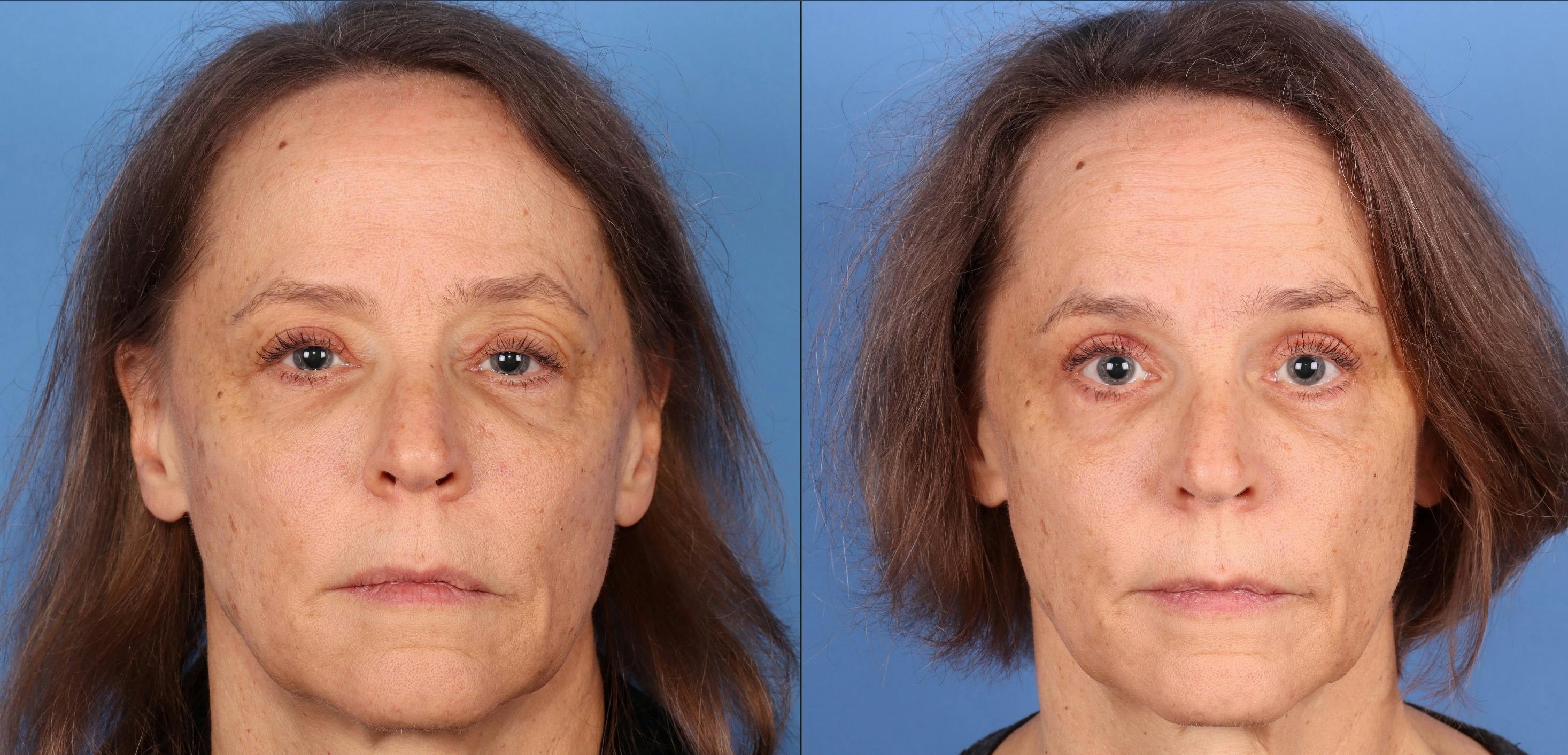 Eyelid Surgery (Upper Blepharoplasty) Before & After Gallery - Patient 331702 - Image 1