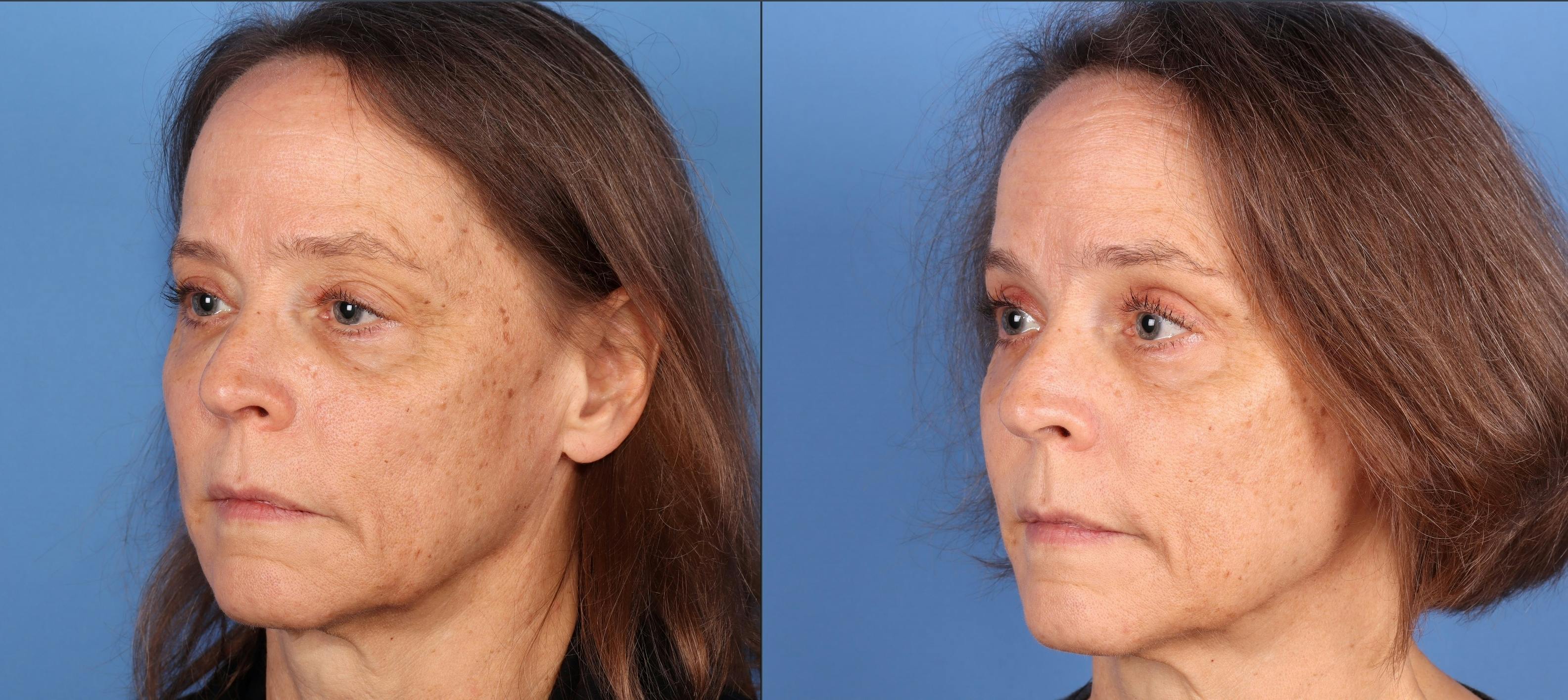 Eyelid Surgery (Upper Blepharoplasty) Before & After Gallery - Patient 331702 - Image 2