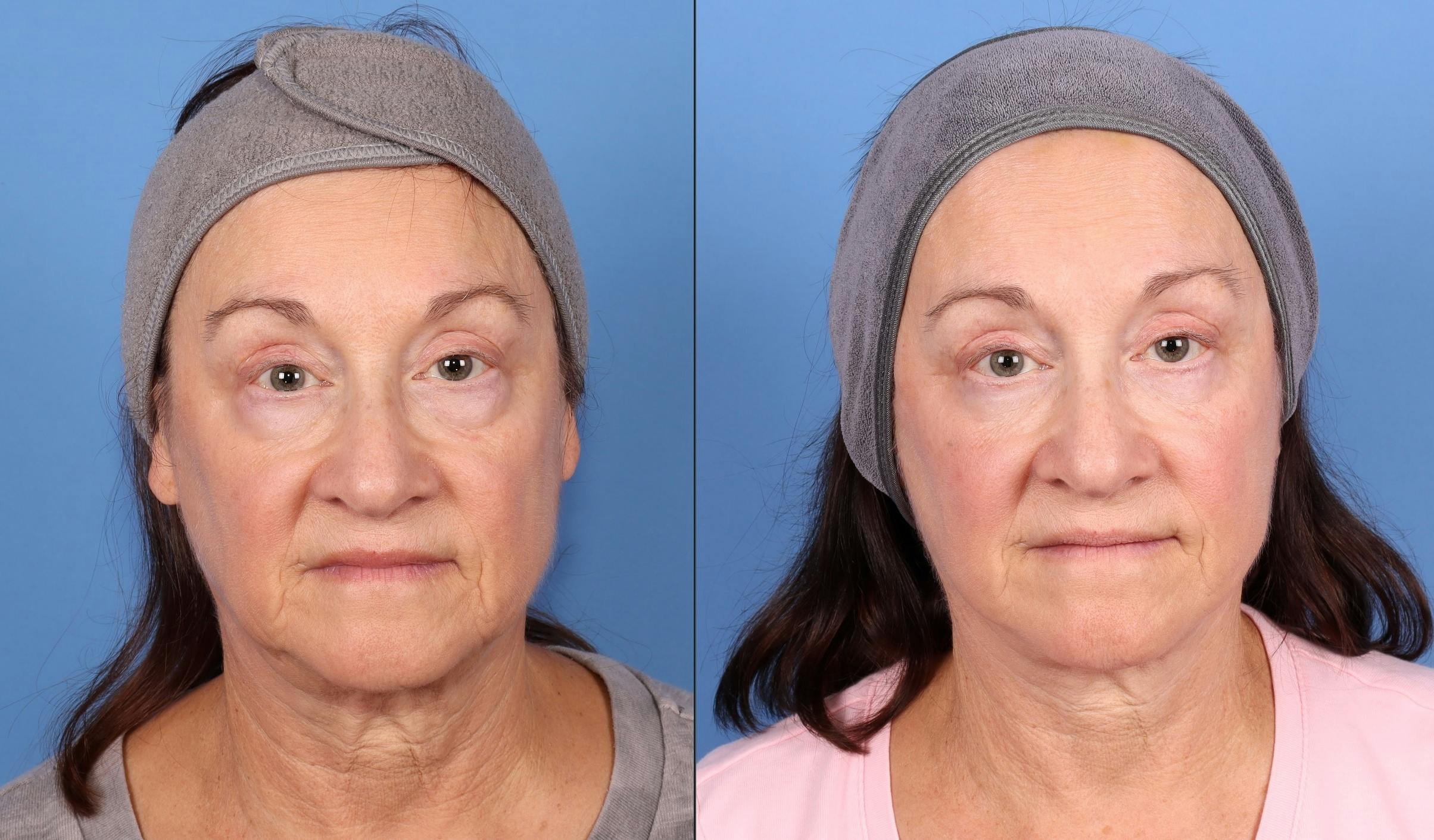 Eyelid Surgery (Lower Blepharoplasty) Before & After Gallery - Patient 407630 - Image 1
