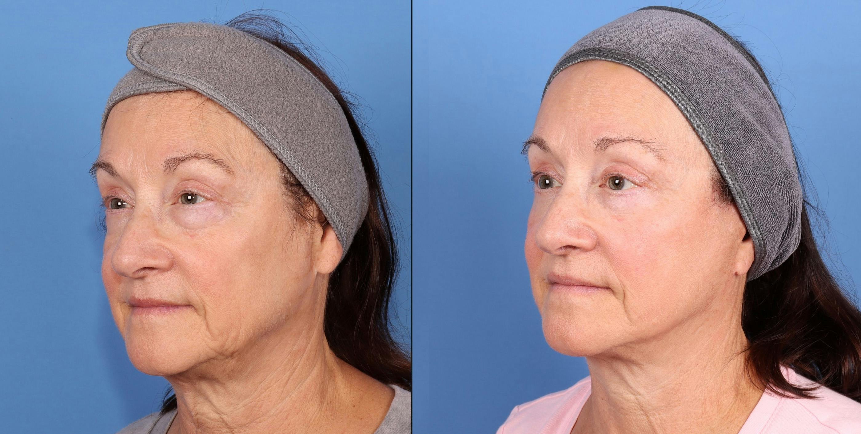 Eyelid Surgery (Lower Blepharoplasty) Before & After Gallery - Patient 407630 - Image 2