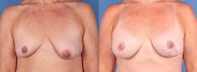 Breast Lift with Augmentation Before & After Gallery - Patient 355456 - Image 1