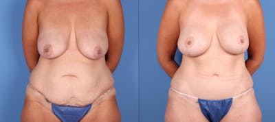 Mommy Makeover Before & After Gallery - Patient 320014 - Image 1