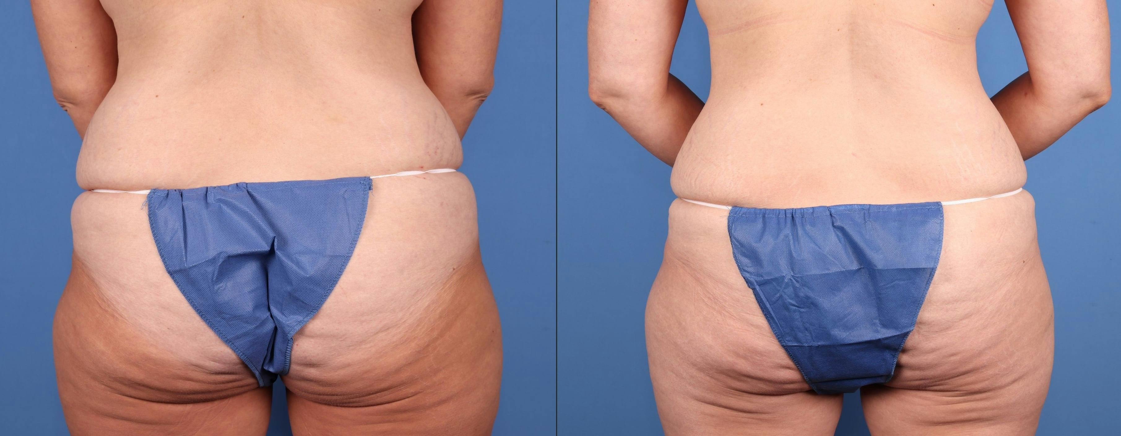 Tummy Tuck Before & After Gallery - Patient 816741 - Image 5
