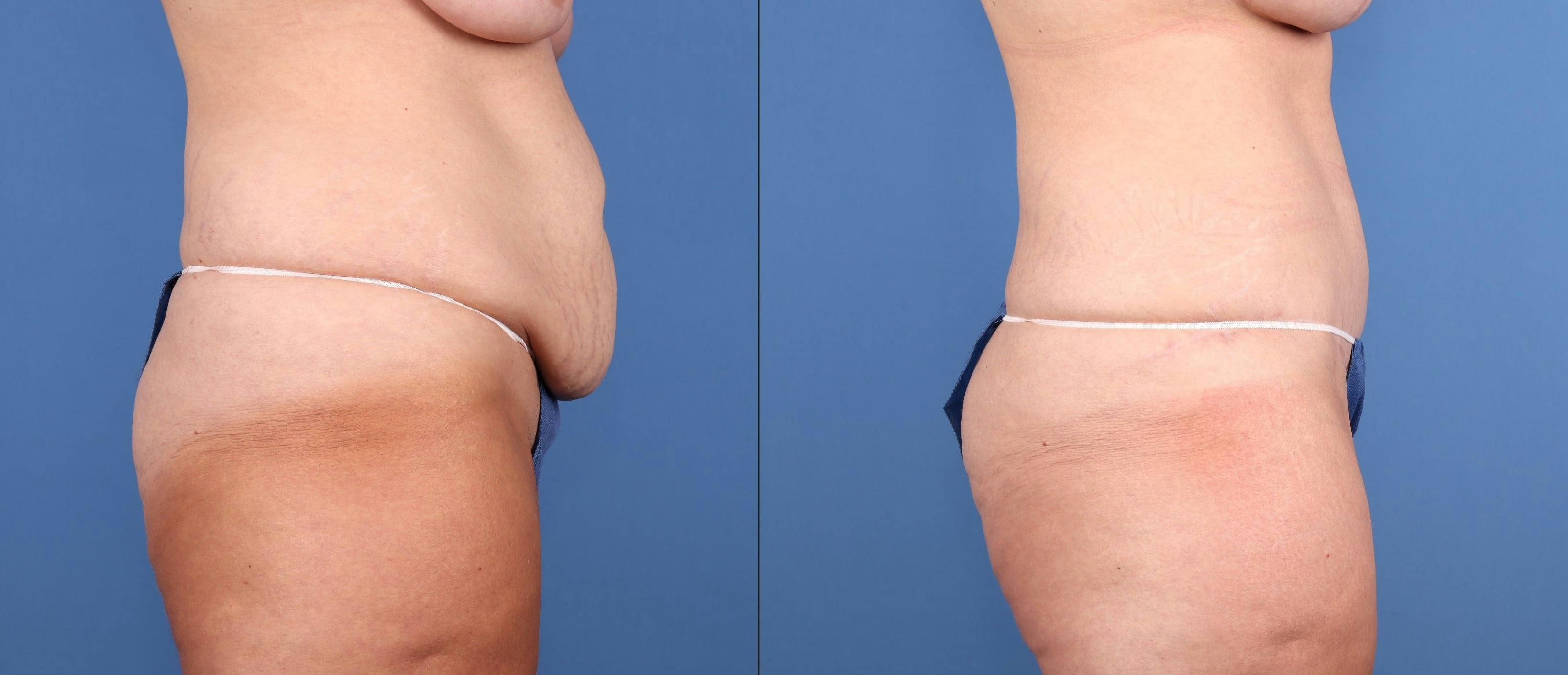 Tummy Tuck Before & After Gallery - Patient 816741 - Image 3
