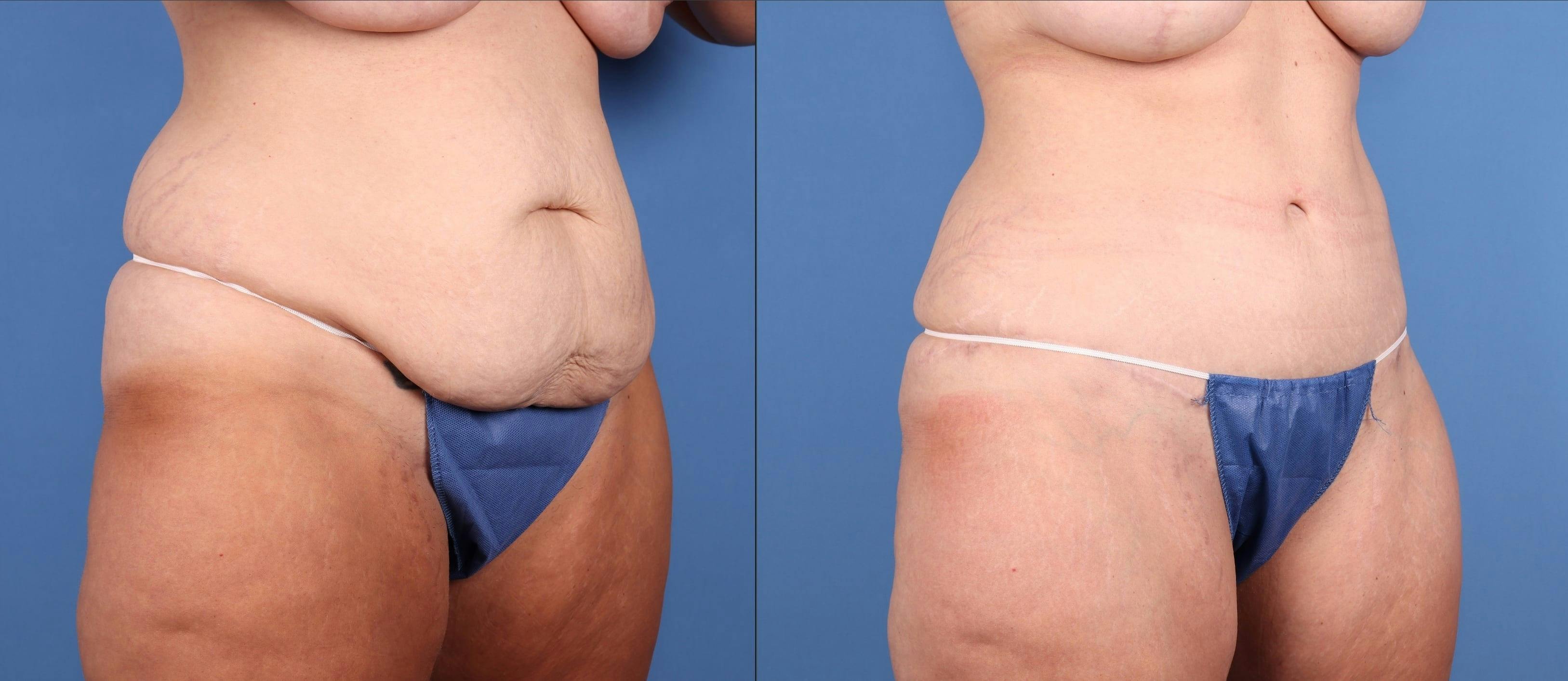 Tummy Tuck Before & After Gallery - Patient 816741 - Image 2