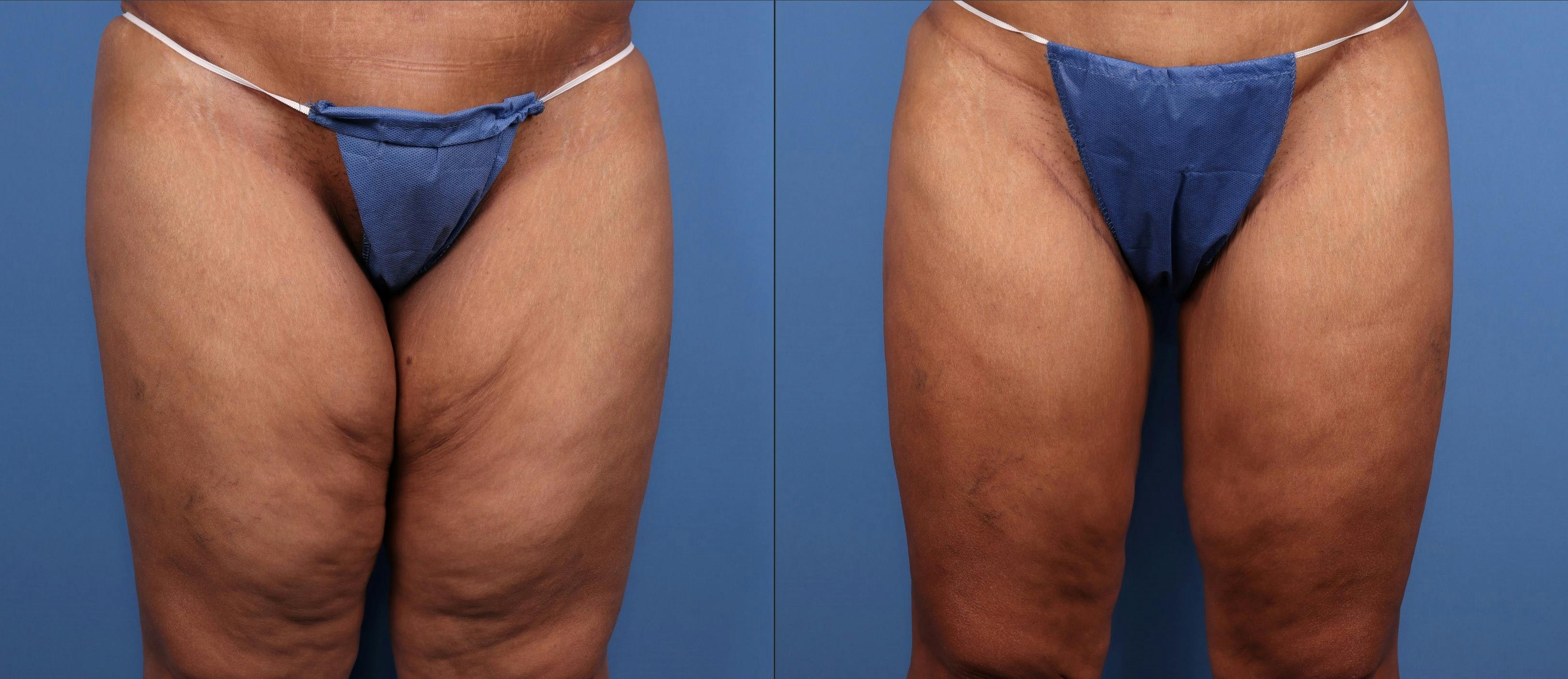 Thigh Lift Before & After Gallery - Patient 414936 - Image 1