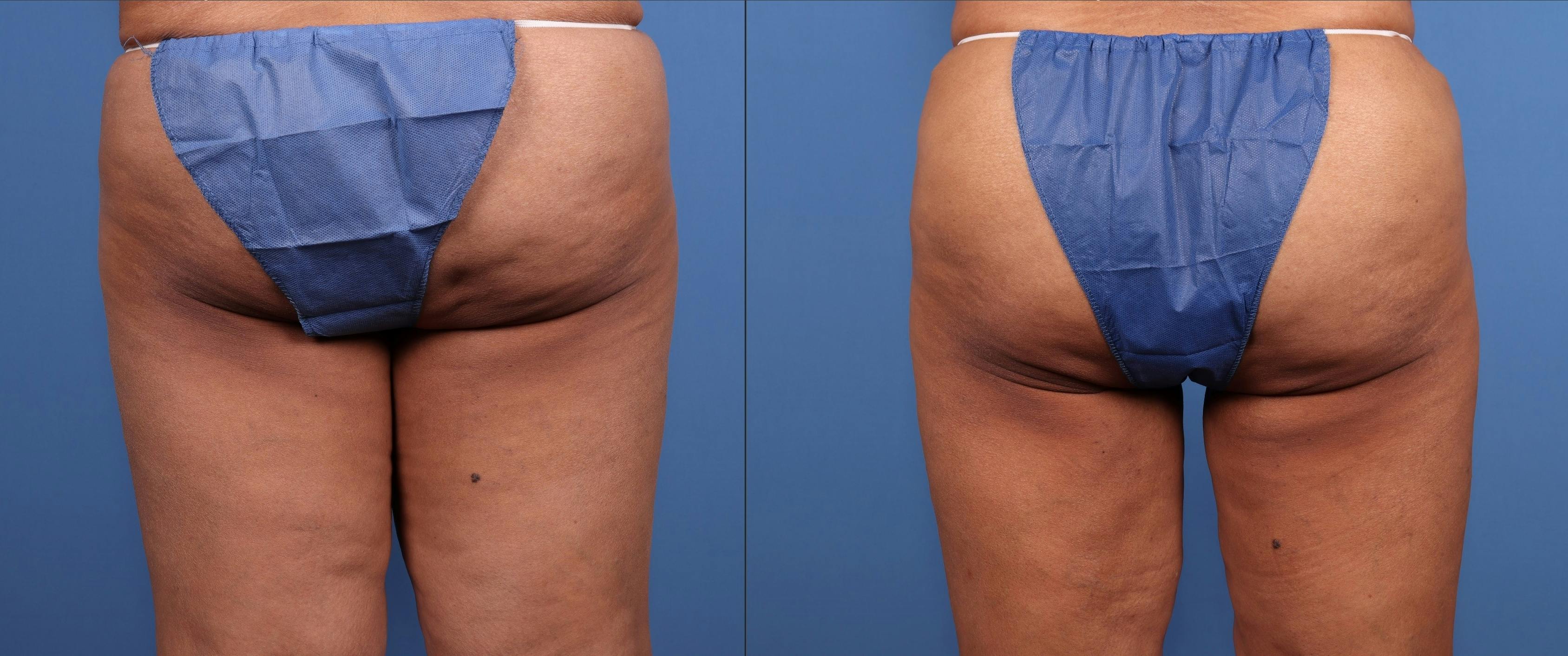 Thigh Lift Before & After Gallery - Patient 414936 - Image 4