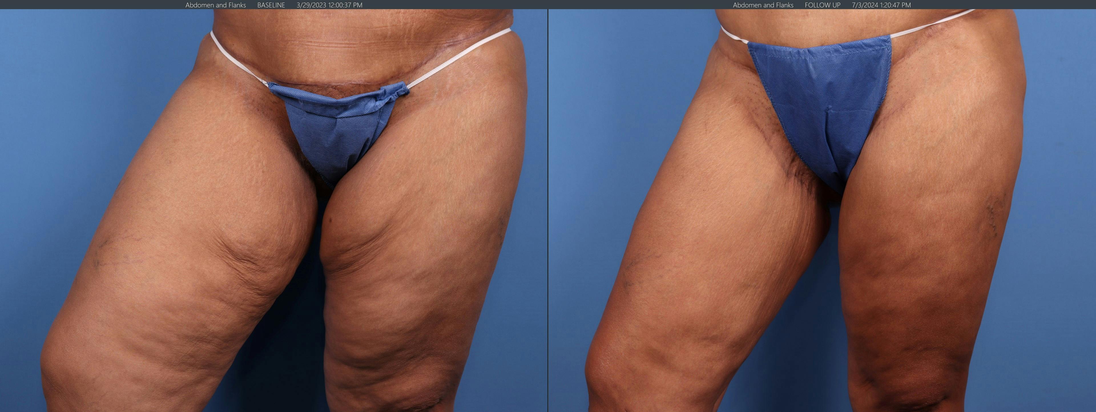 Thigh Lift Before & After Gallery - Patient 414936 - Image 3