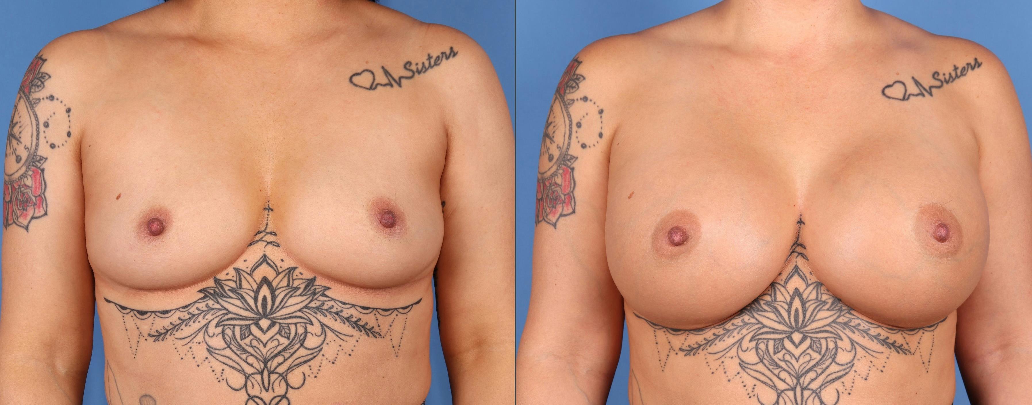 Breast Augmentation Before & After Gallery - Patient 266430 - Image 1