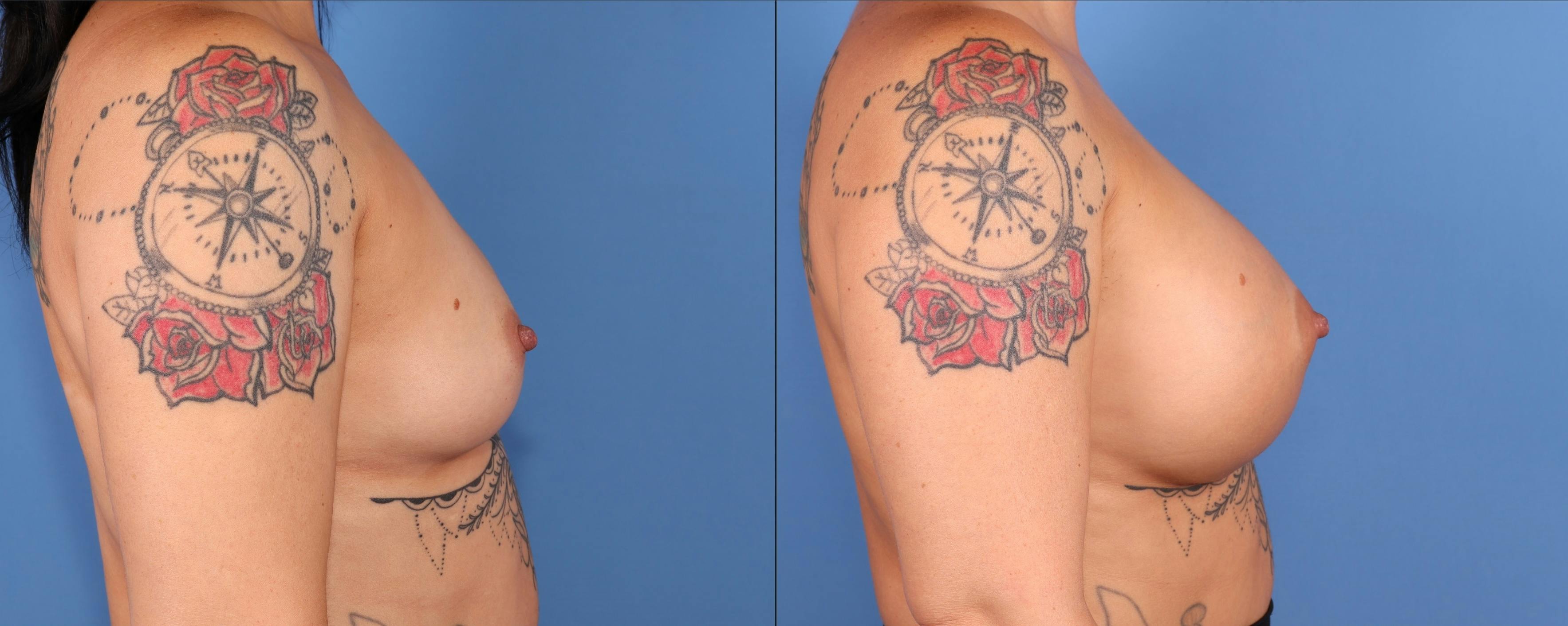 Breast Augmentation Before & After Gallery - Patient 266430 - Image 3