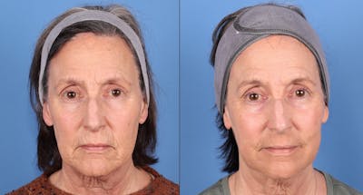 Contour TRL Laser Before & After Gallery - Patient 307405 - Image 1