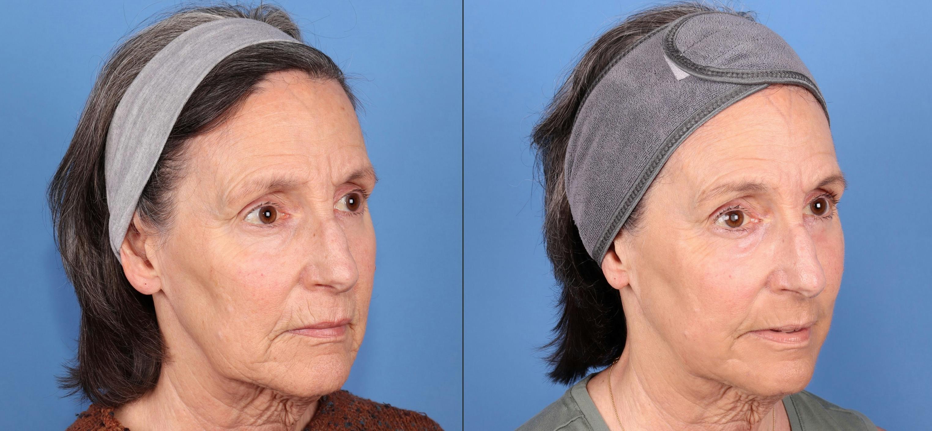 Contour TRL Laser Before & After Gallery - Patient 307405 - Image 2