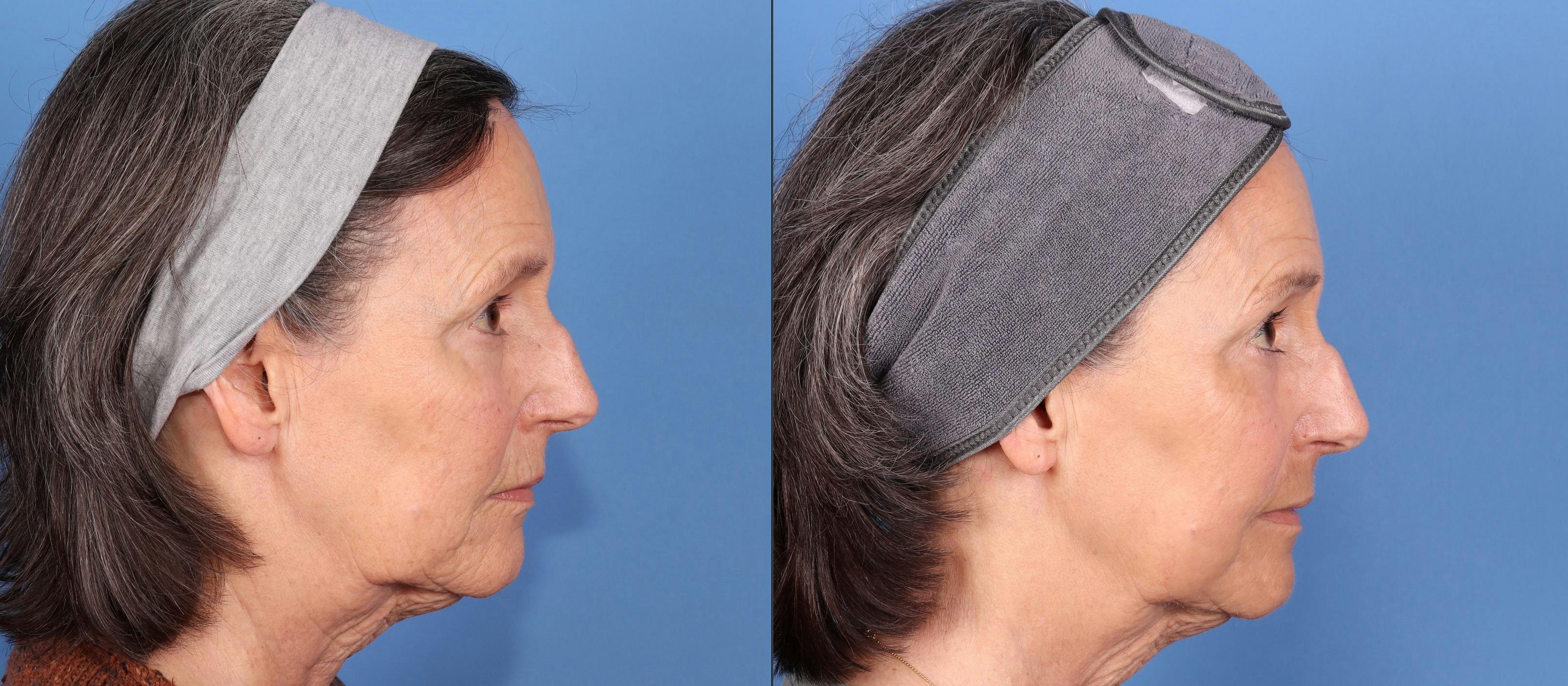 Contour TRL Laser Before & After Gallery - Patient 307405 - Image 3