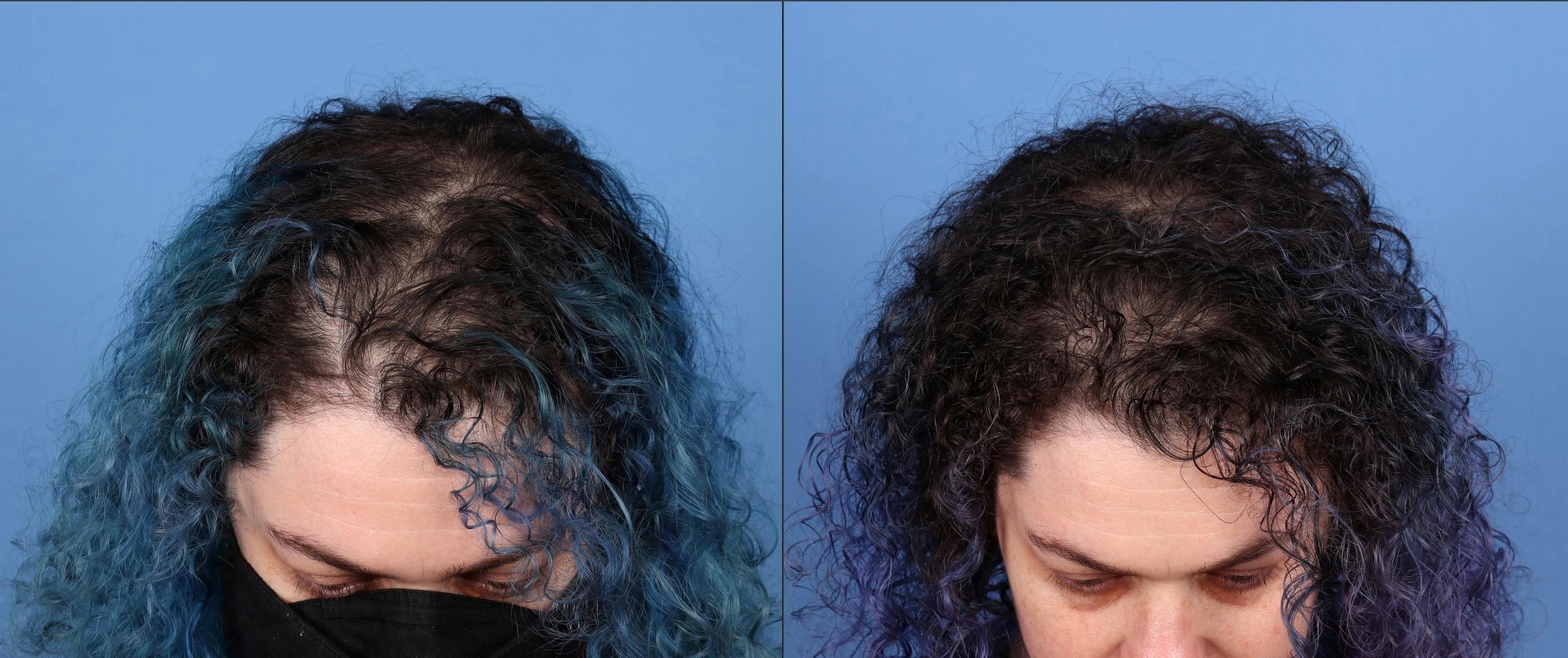 Female Hair Restoration Before & After Gallery - Patient 175247 - Image 1