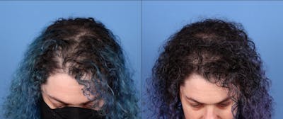 PRP Hair Treatments Before & After Gallery - Patient 192482 - Image 1