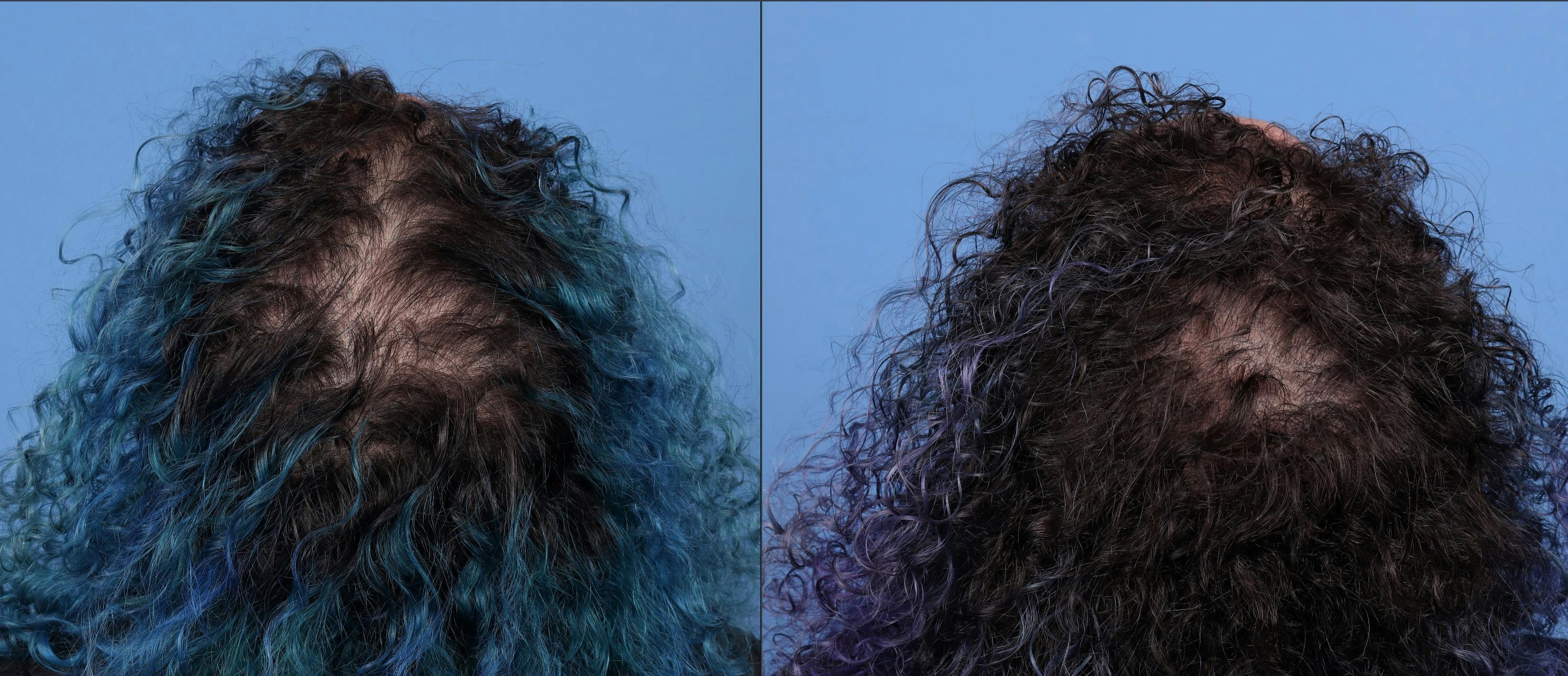 Female Hair Restoration Before & After Gallery - Patient 175247 - Image 3