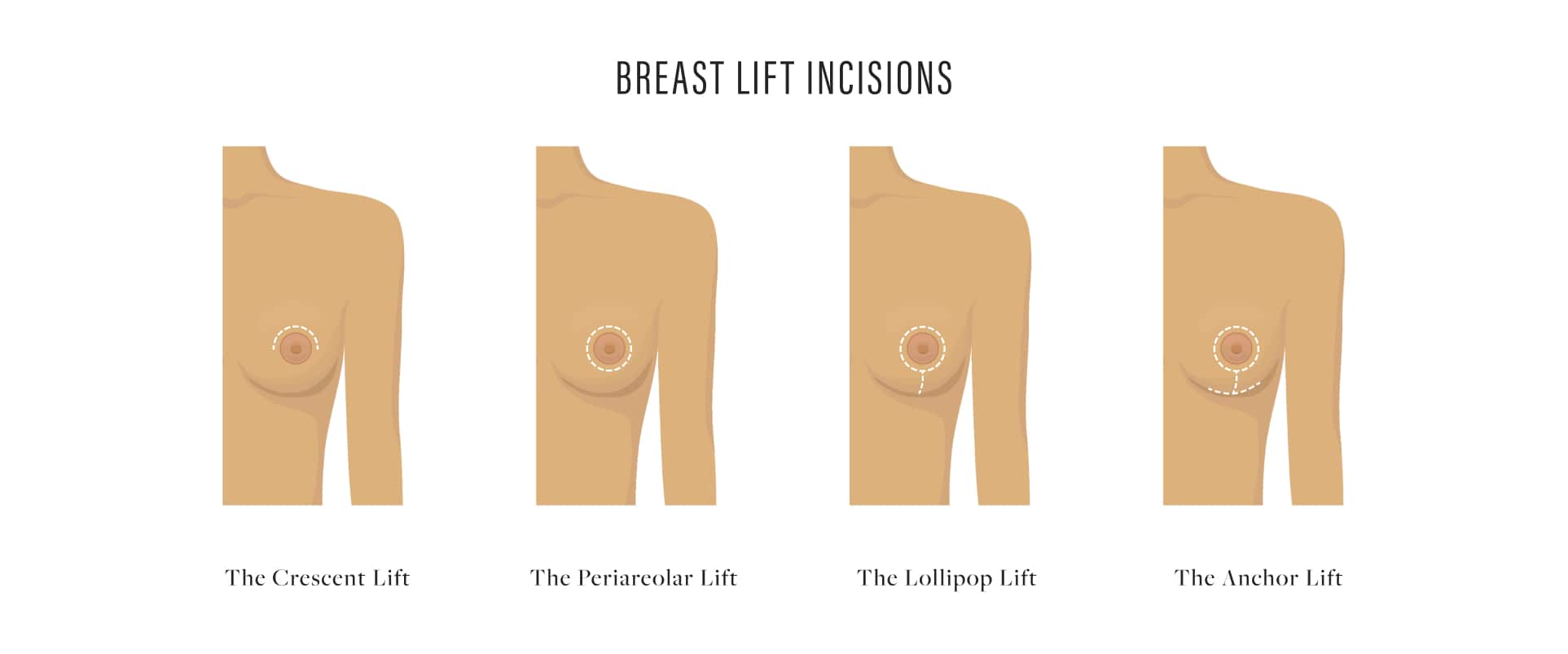 breast lift incision infographic