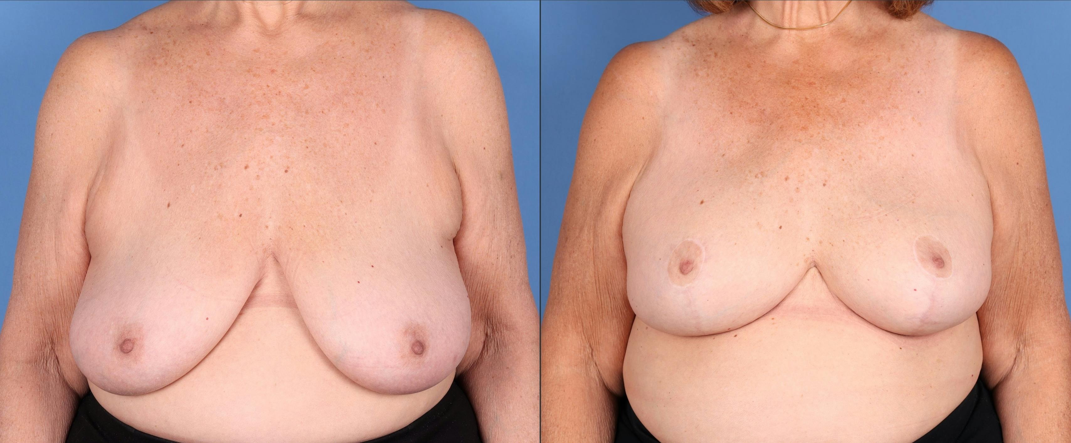 Breast Augmentation Before & After Gallery - Patient 656455 - Image 1